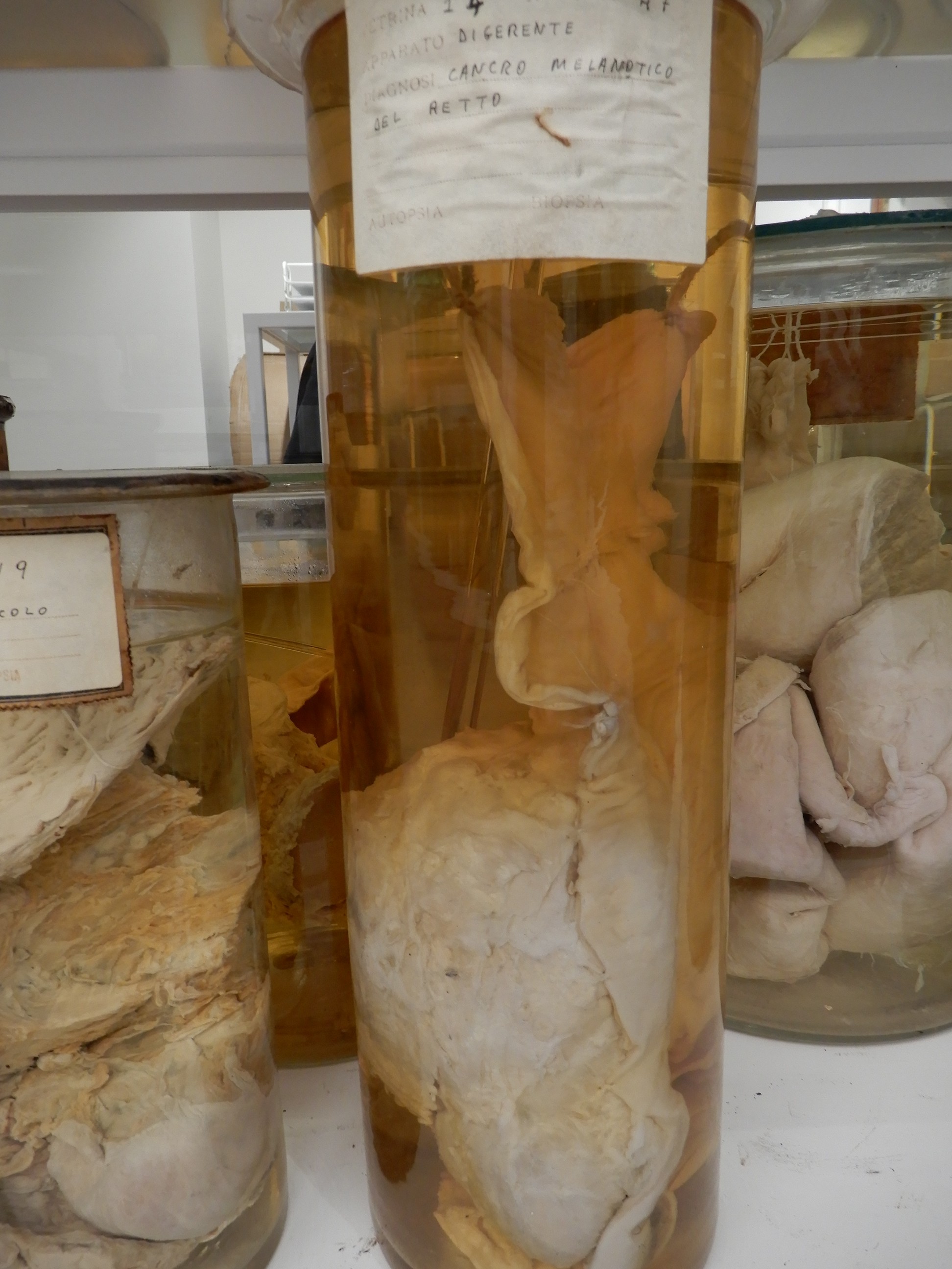 singolo reperto antropologico, preparato anatomico (morfologia alterata per patologia) (XIX-XX)