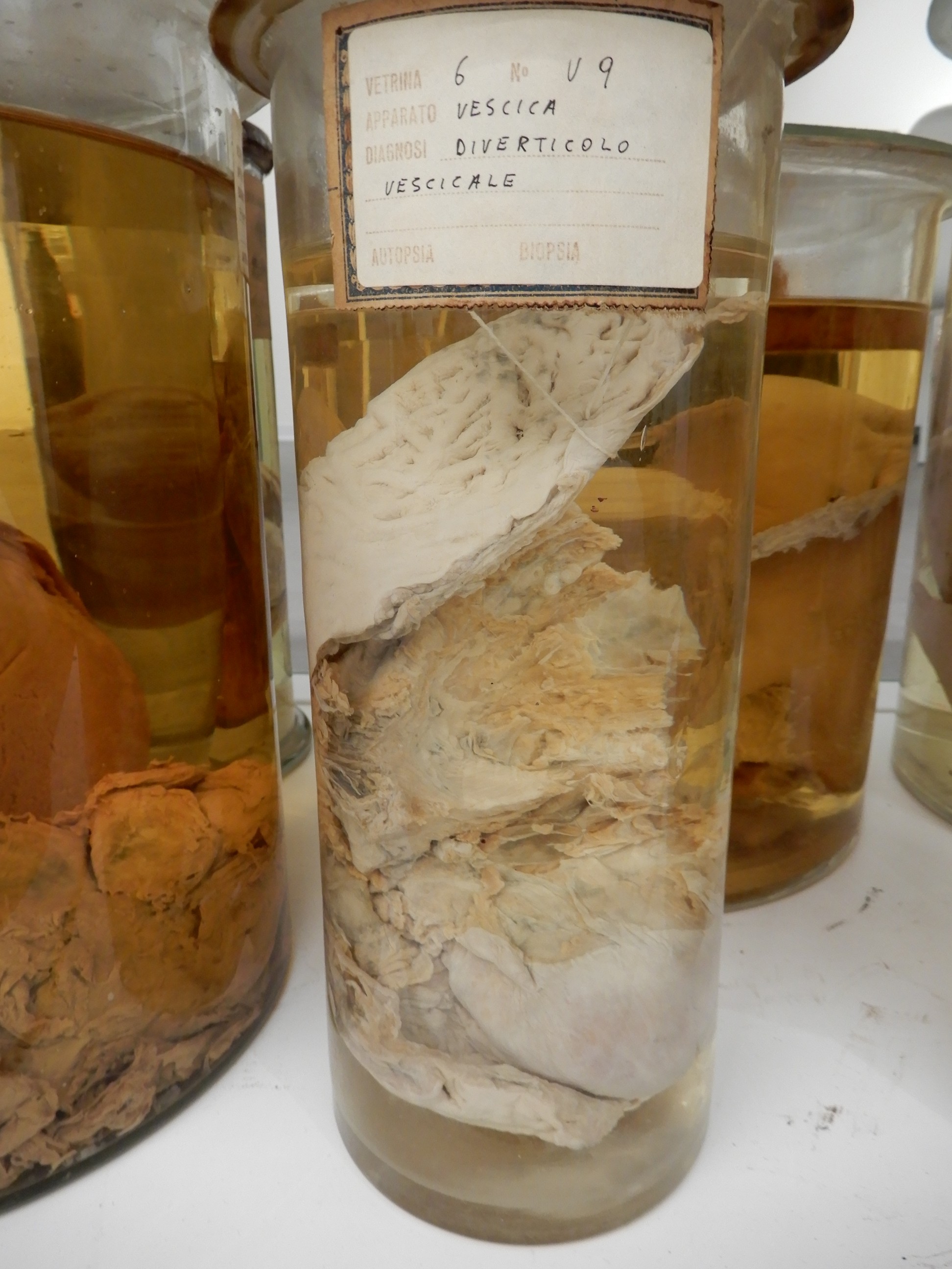 singolo reperto antropologico, preparato anatomico (morfologia alterata per patologia) (XIX-XX)