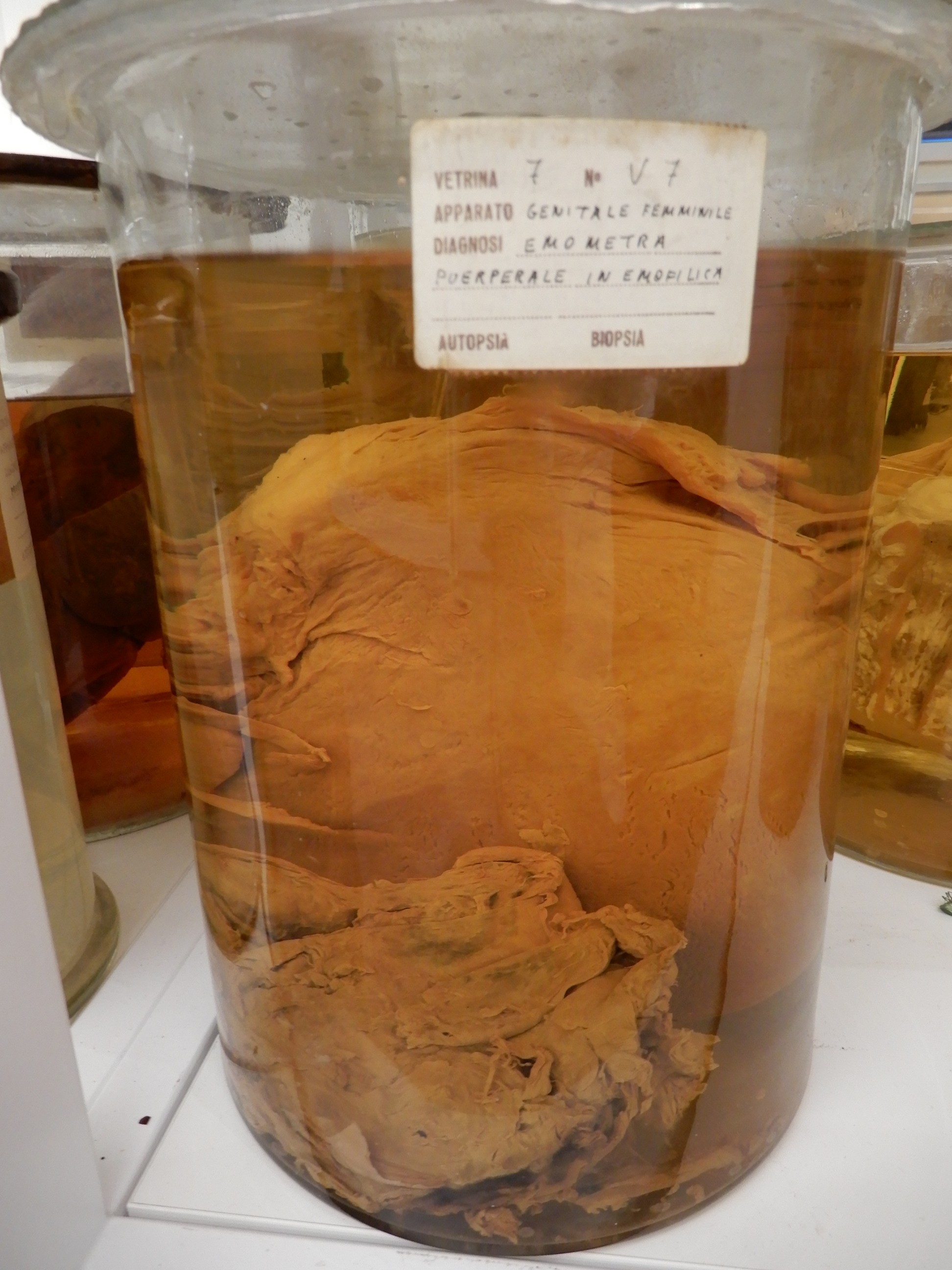 singolo reperto antropologico, preparato anatomico (morfologia alterata per patologia) (XIX-XX)