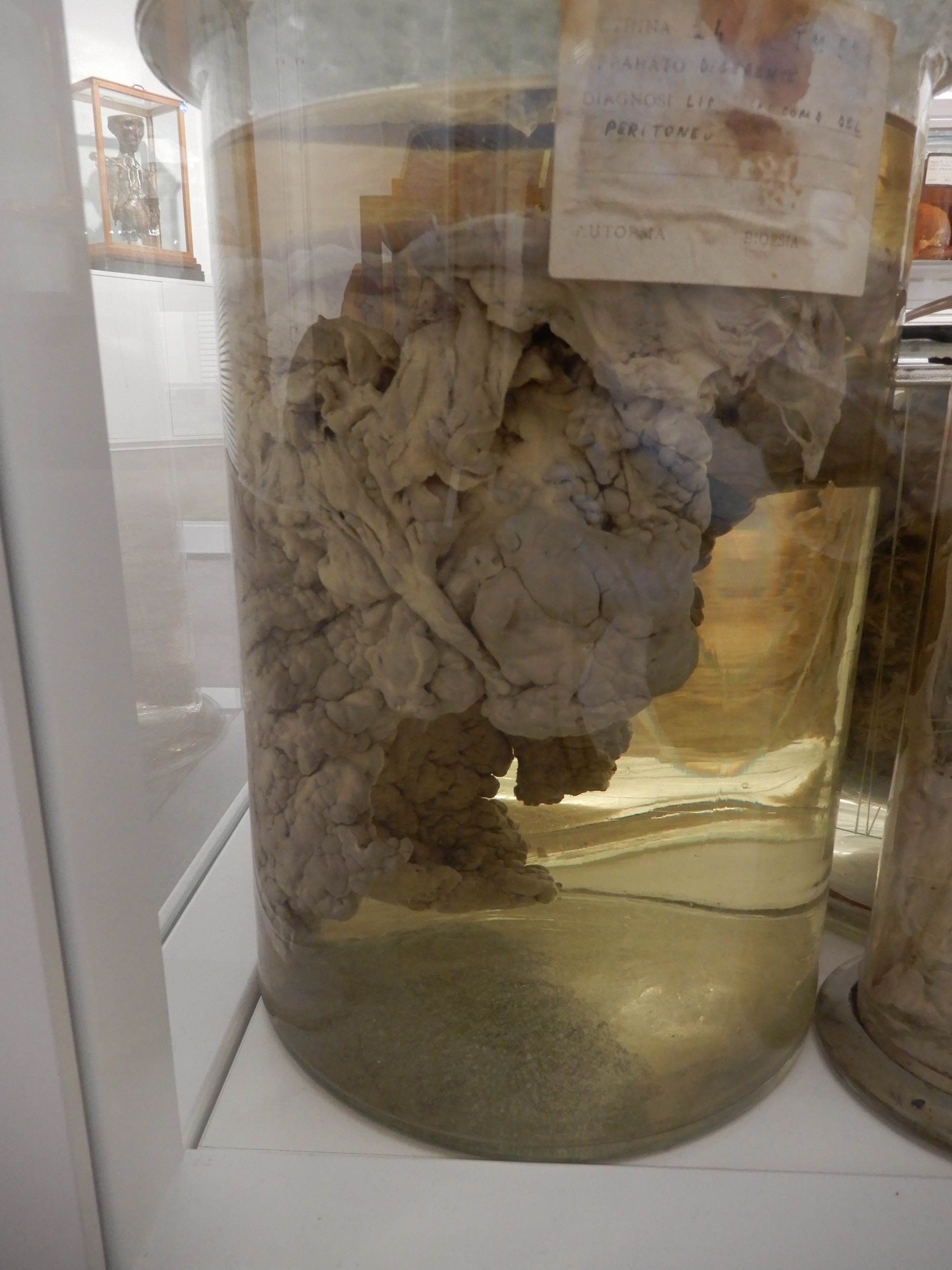 singolo reperto antropologico, preparato anatomico (morfologia alterata per patologia) (XIX-XX)