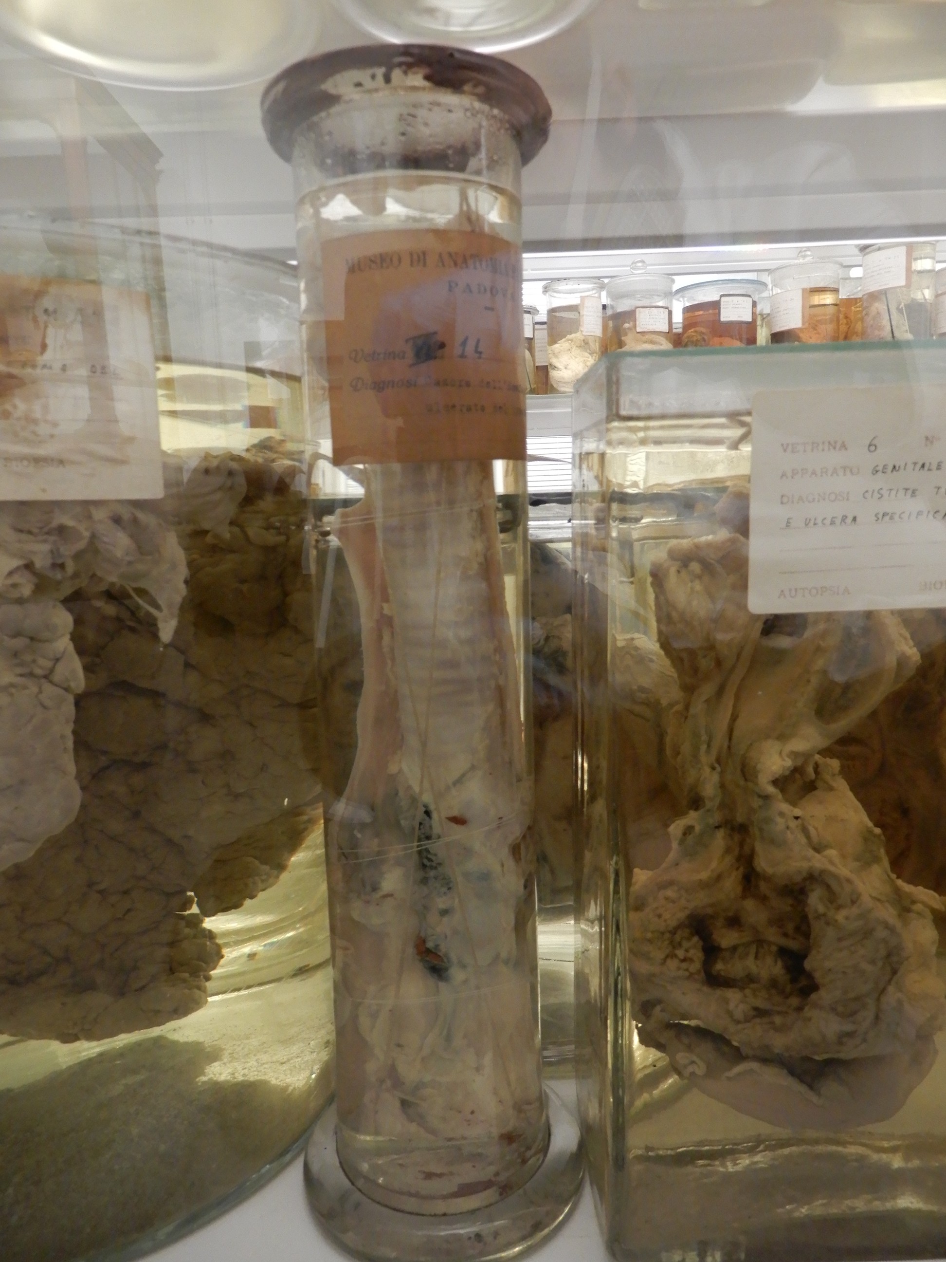 singolo reperto antropologico, preparato anatomico (morfologia alterata per patologia) (XIX-XX)