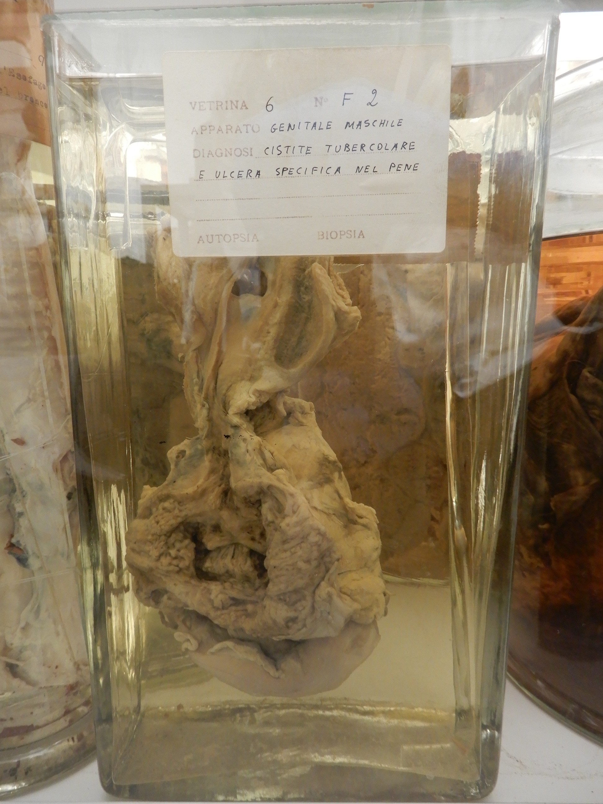 singolo reperto antropologico, preparato anatomico (morfologia alterata per patologia) (XIX-XX)