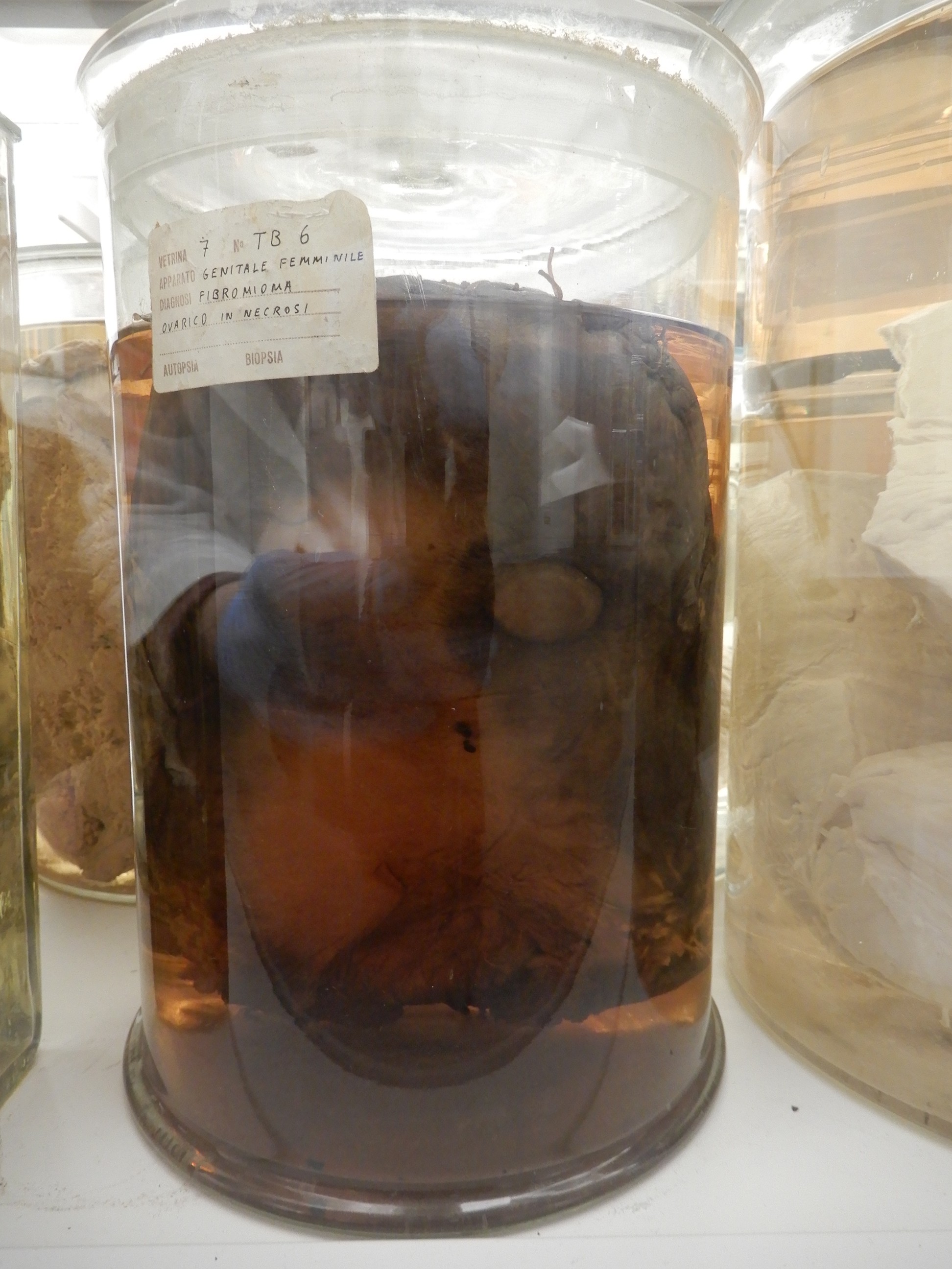 singolo reperto antropologico, preparato anatomico (morfologia alterata per patologia) (XIX-XX)