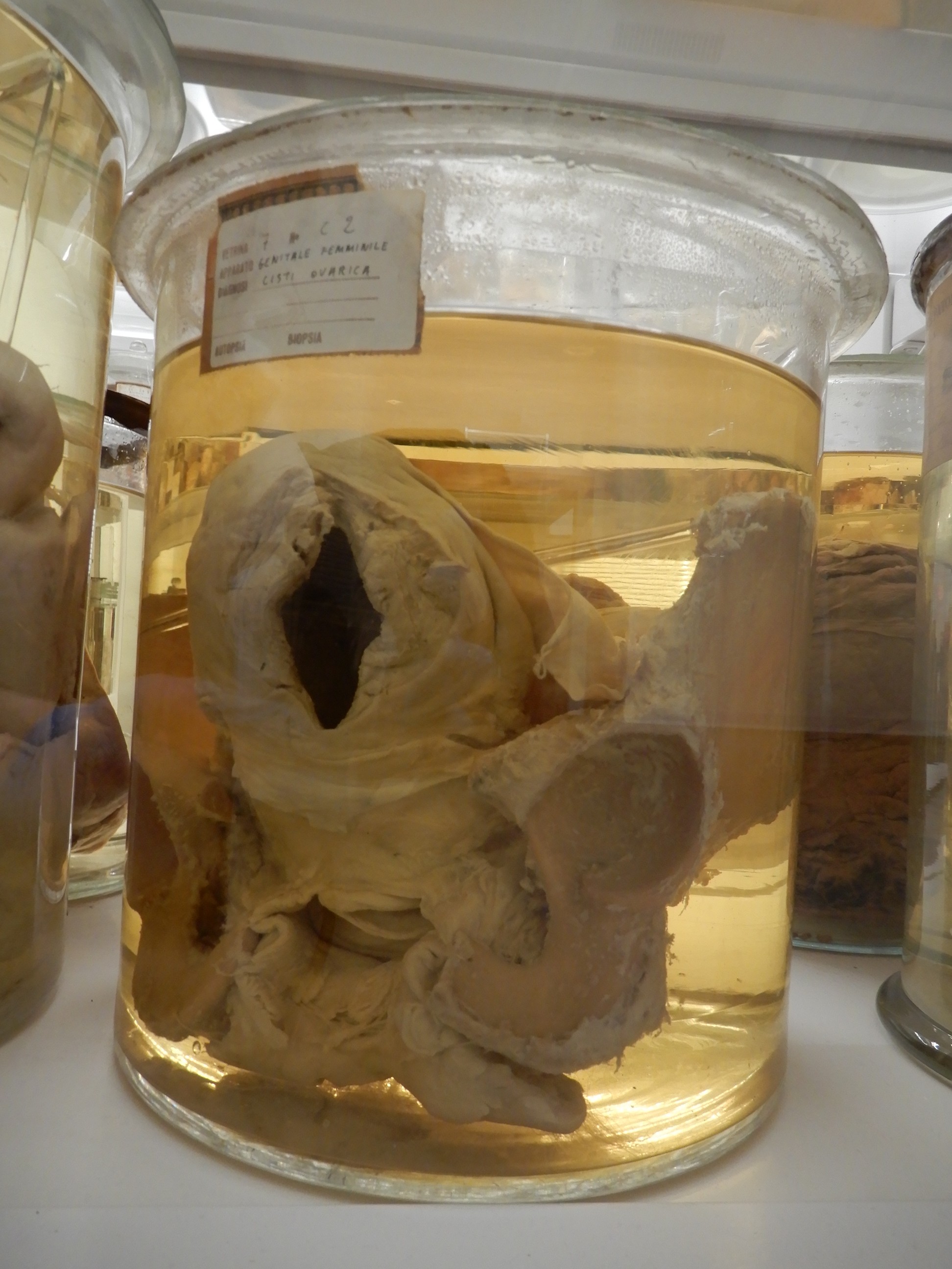 singolo reperto antropologico, preparato anatomico (morfologia alterata per patologia) (XIX-XX)