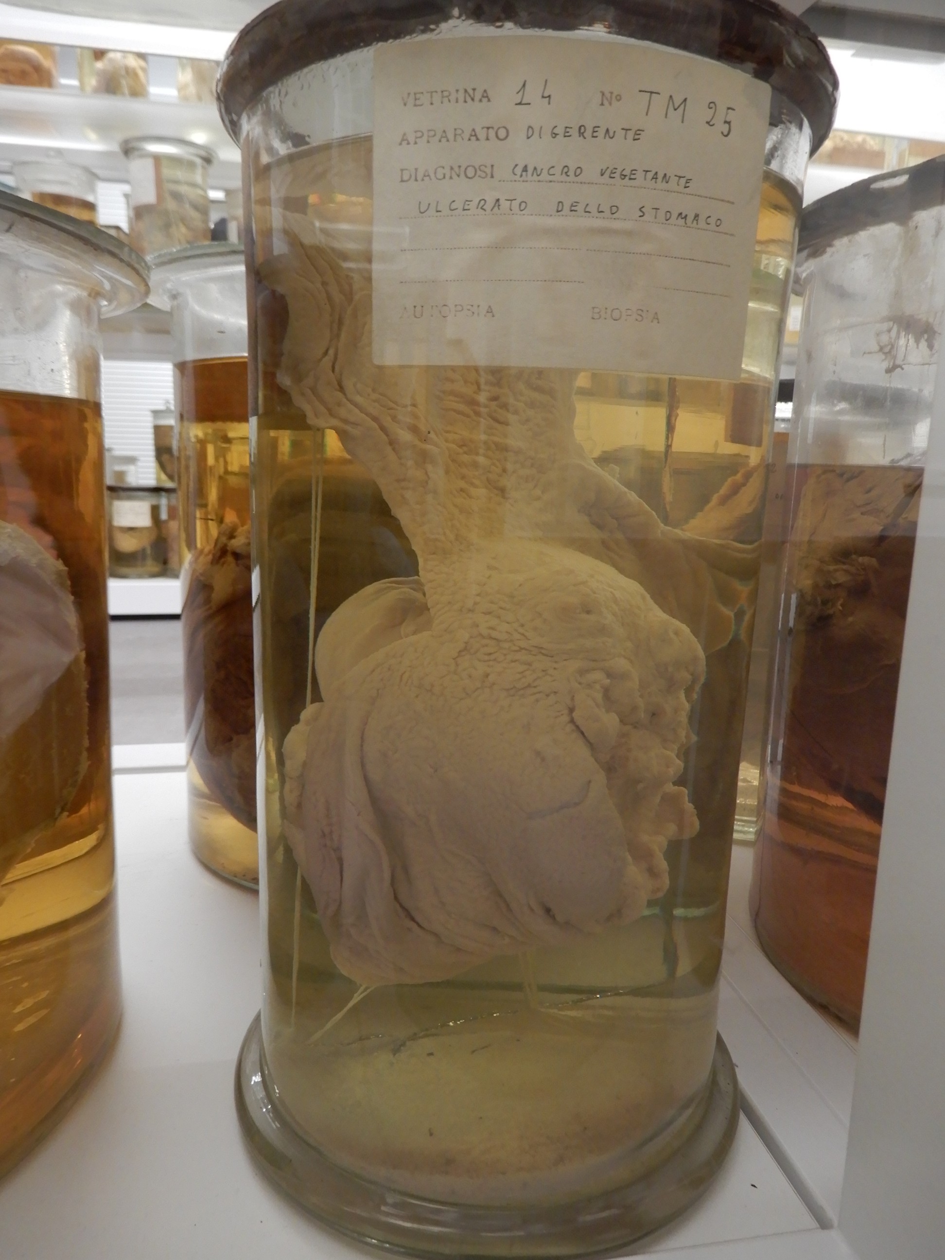 singolo reperto antropologico, preparato anatomico (morfologia alterata per patologia) (XIX-XX)