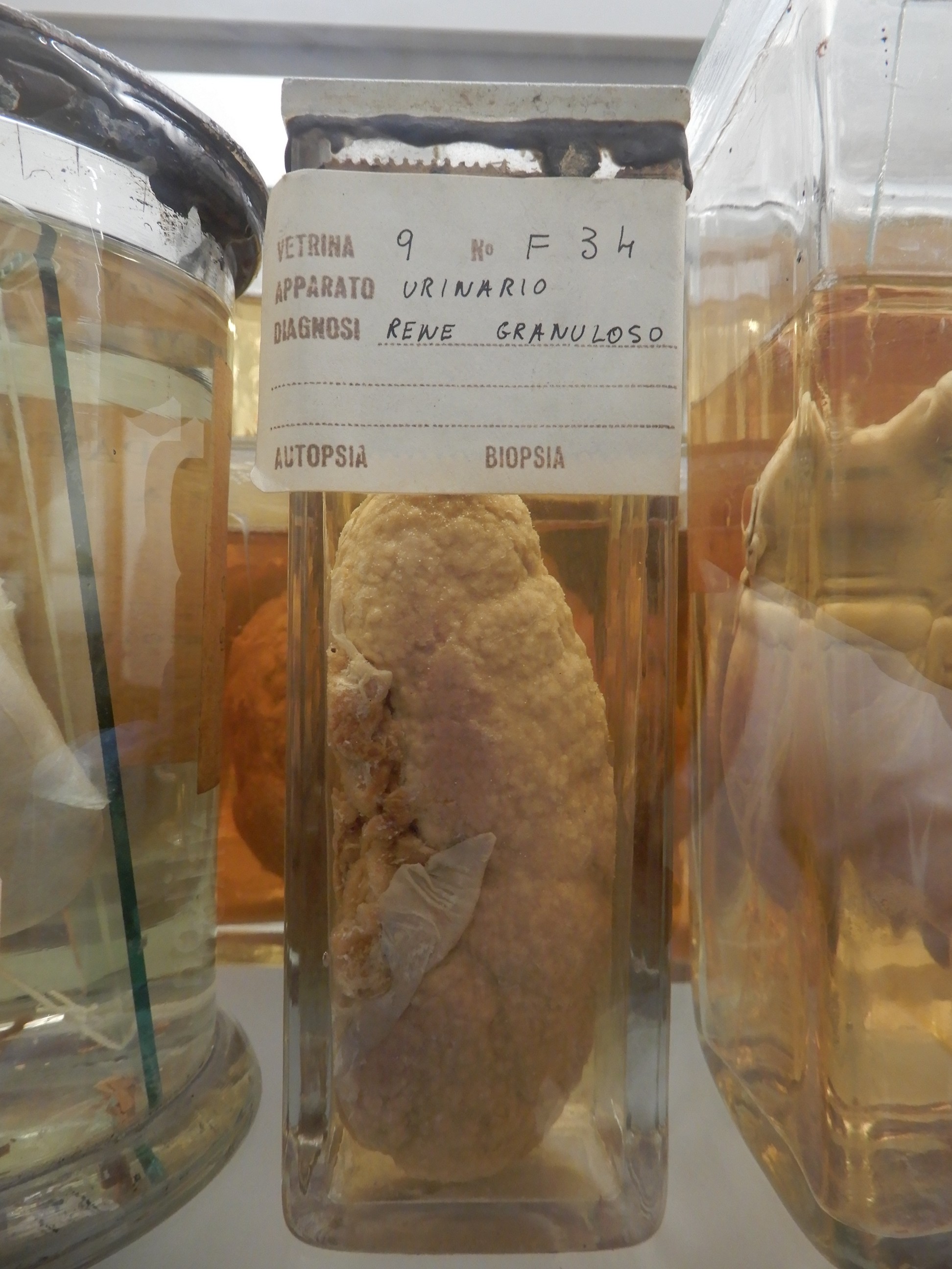 singolo reperto antropologico, preparato anatomico (morfologia alterata per patologia) (XIX-XX)