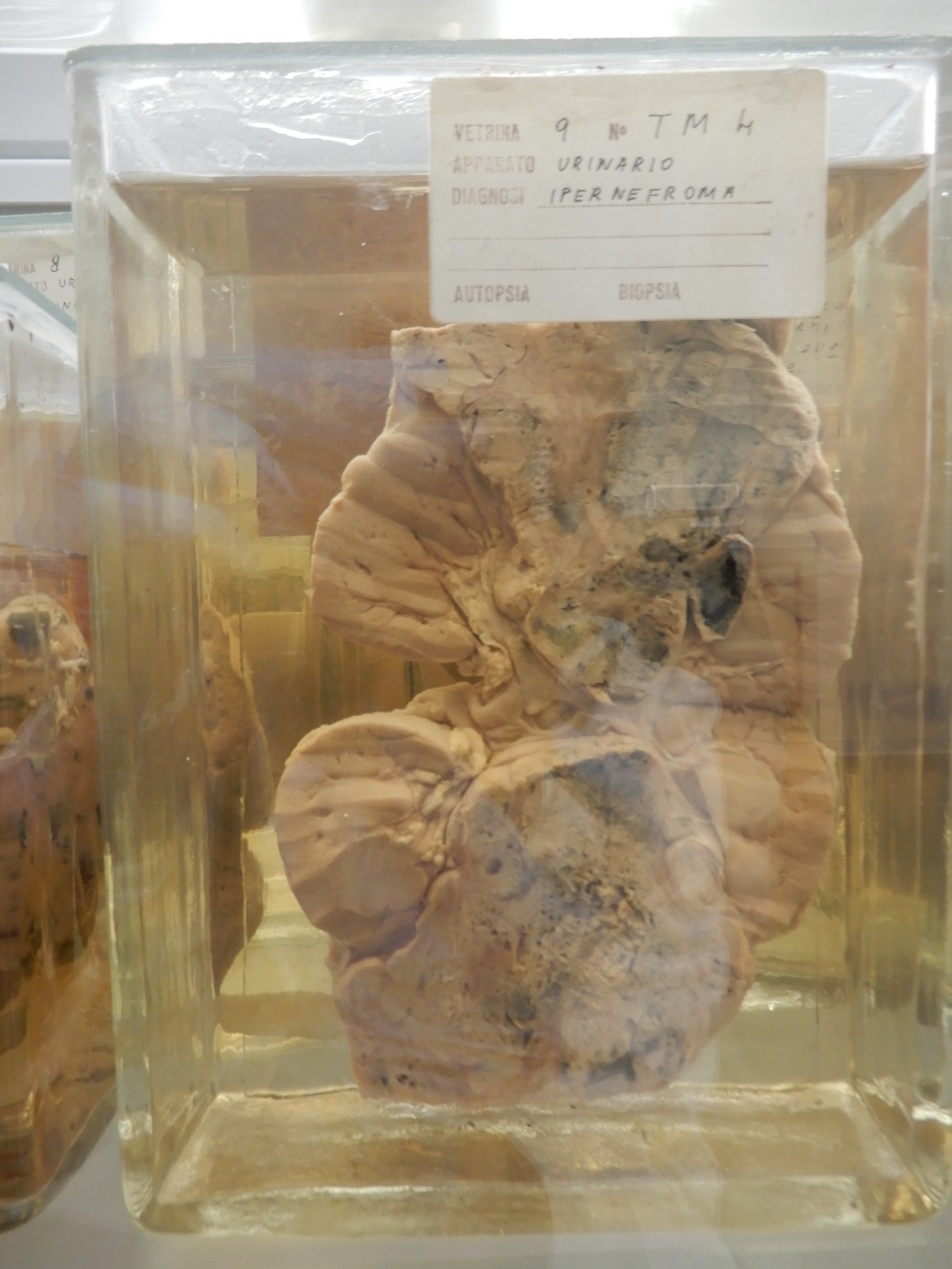 singolo reperto antropologico, preparato anatomico (morfologia alterata per patologia) (XIX-XX)