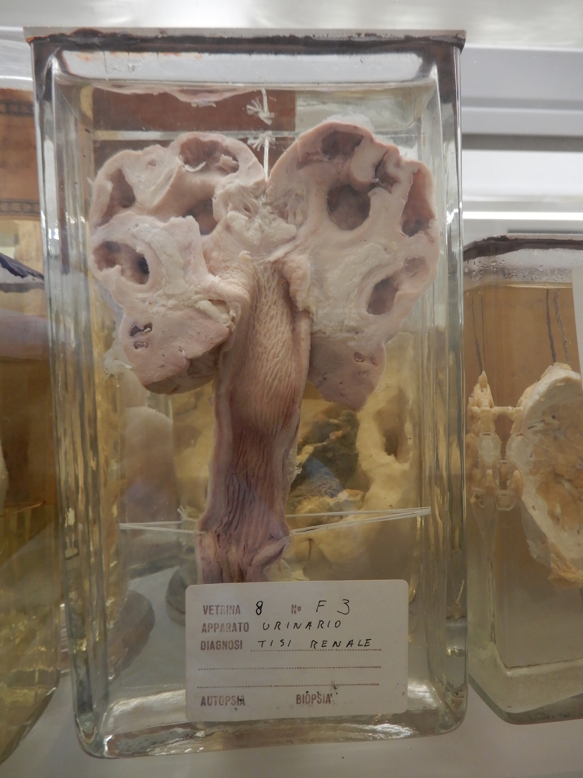 singolo reperto antropologico, preparato anatomico (morfologia alterata per patologia) (XIX-XX)