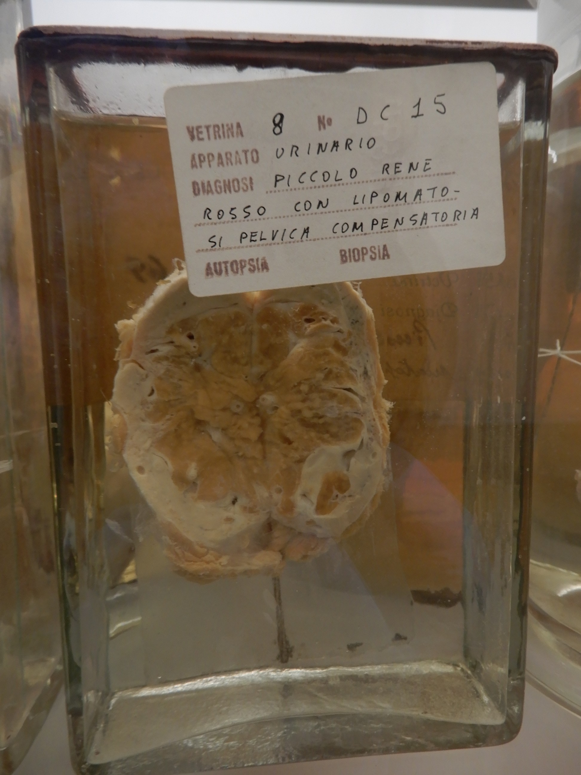 singolo reperto antropologico, preparato anatomico (morfologia alterata per patologia) (XIX-XX)