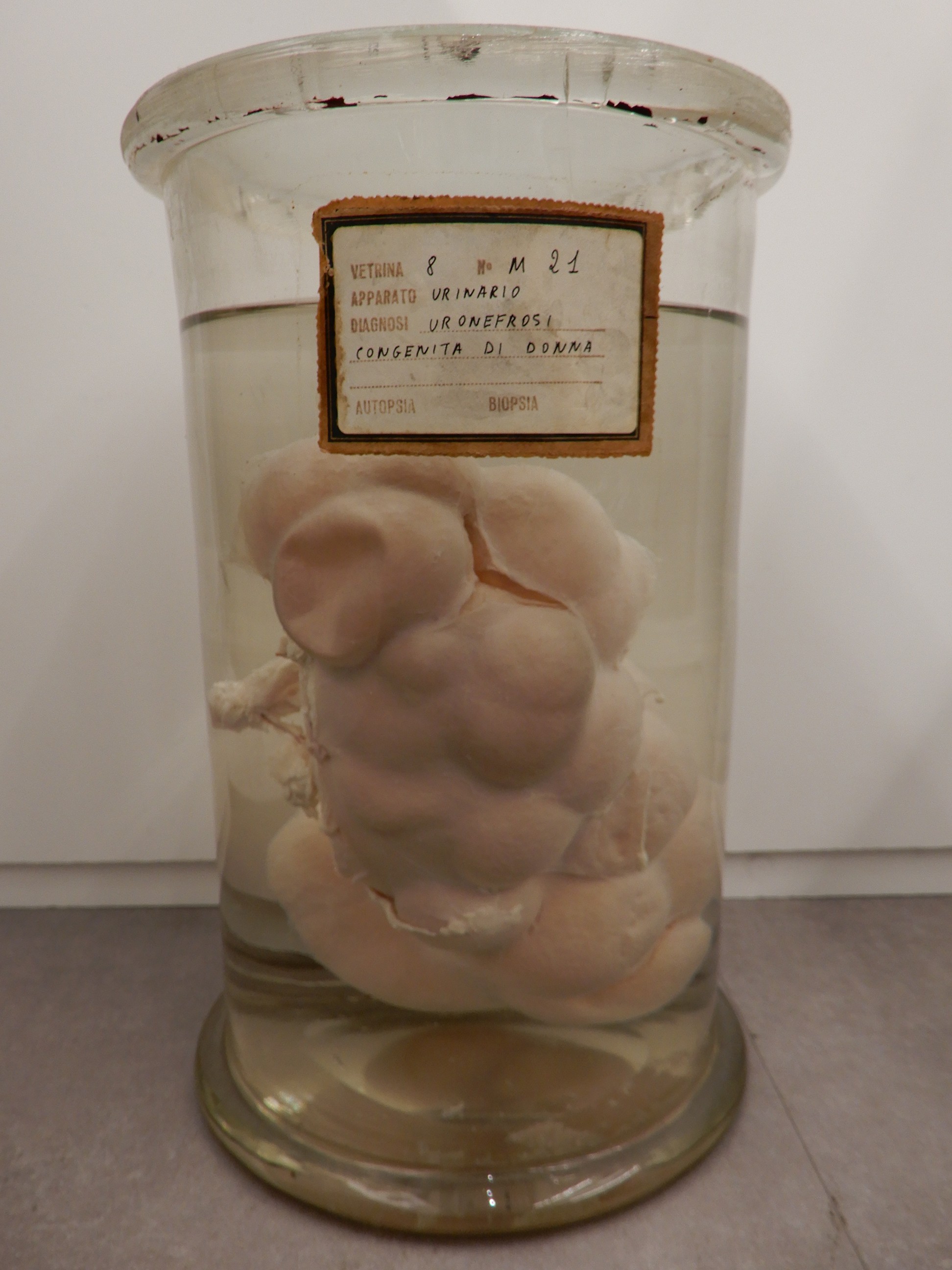 singolo reperto antropologico, preparato anatomico (morfologia alterata per patologia) (XIX-XX)