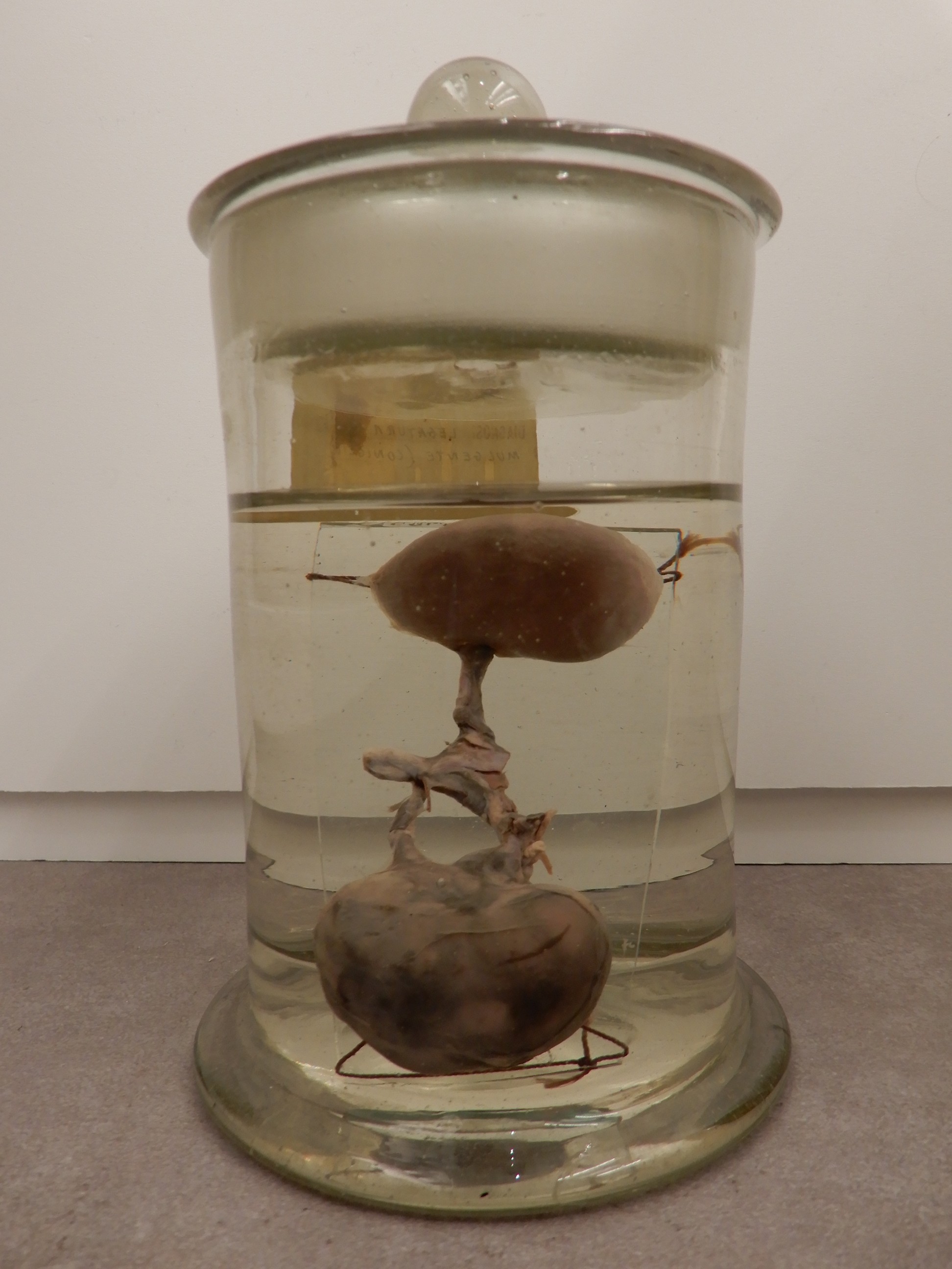 singolo reperto antropologico, preparato anatomico (morfologia alterata per patologia) (XIX-XX)