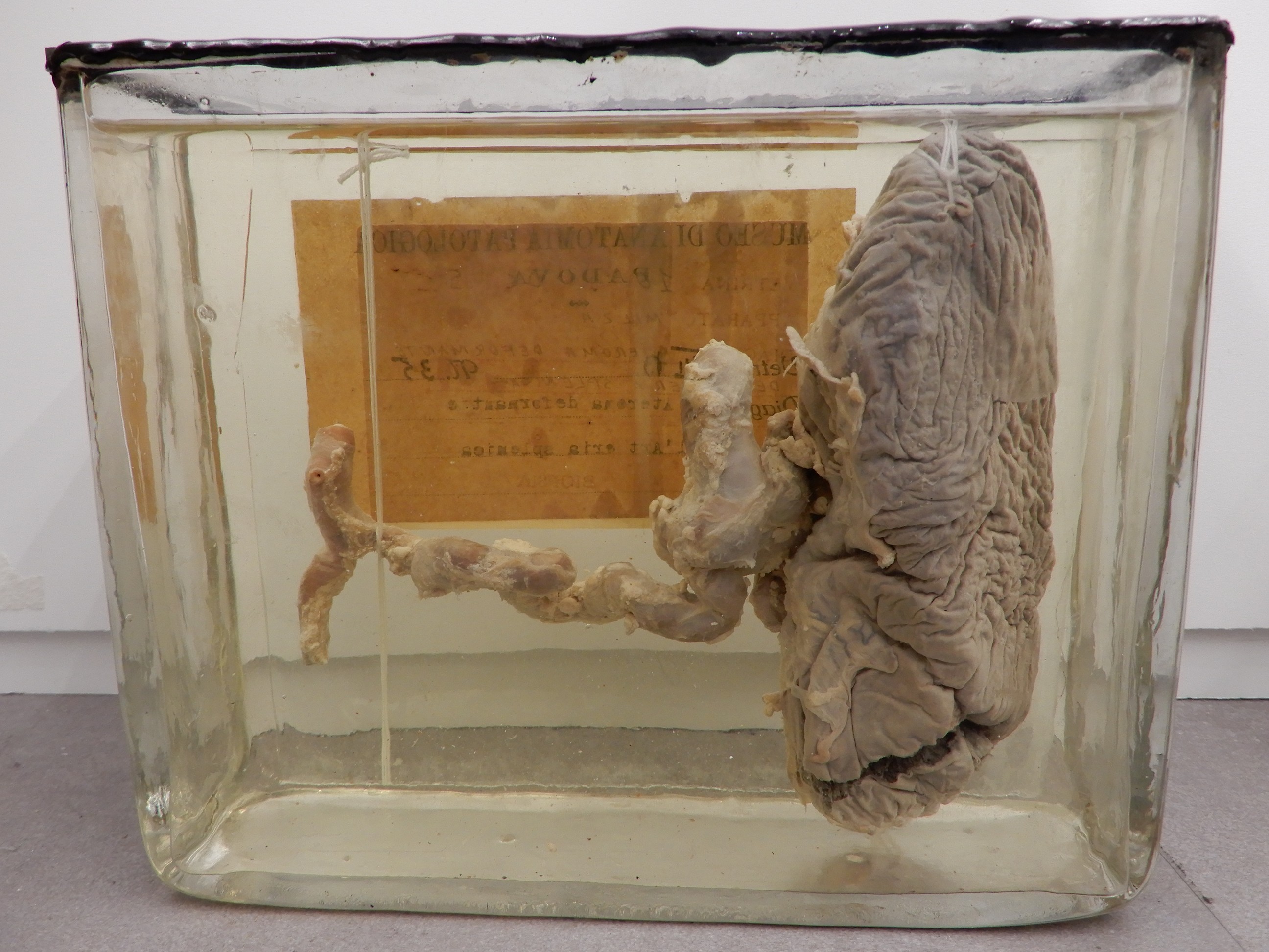 singolo reperto antropologico, preparato anatomico (morfologia alterata per patologia) (XIX-XX)