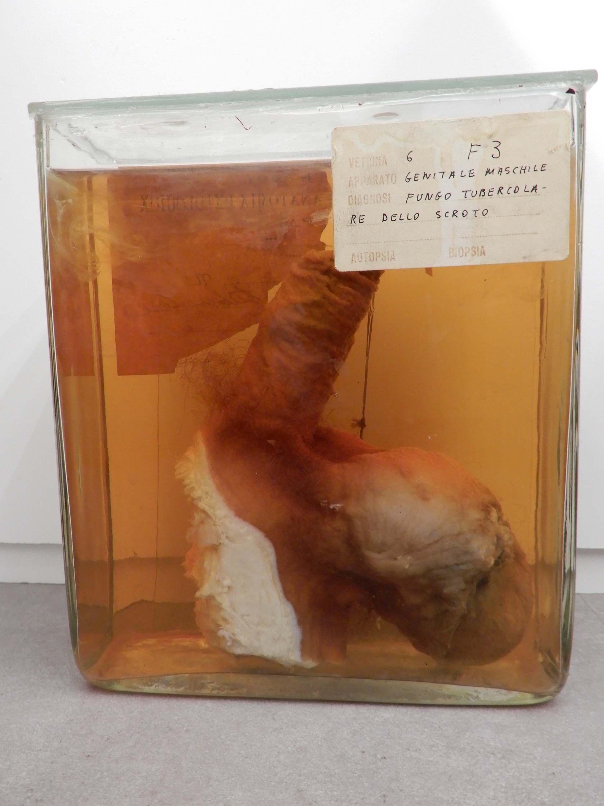 singolo reperto antropologico, preparato anatomico (morfologia alterata per patologia) (XIX-XX)