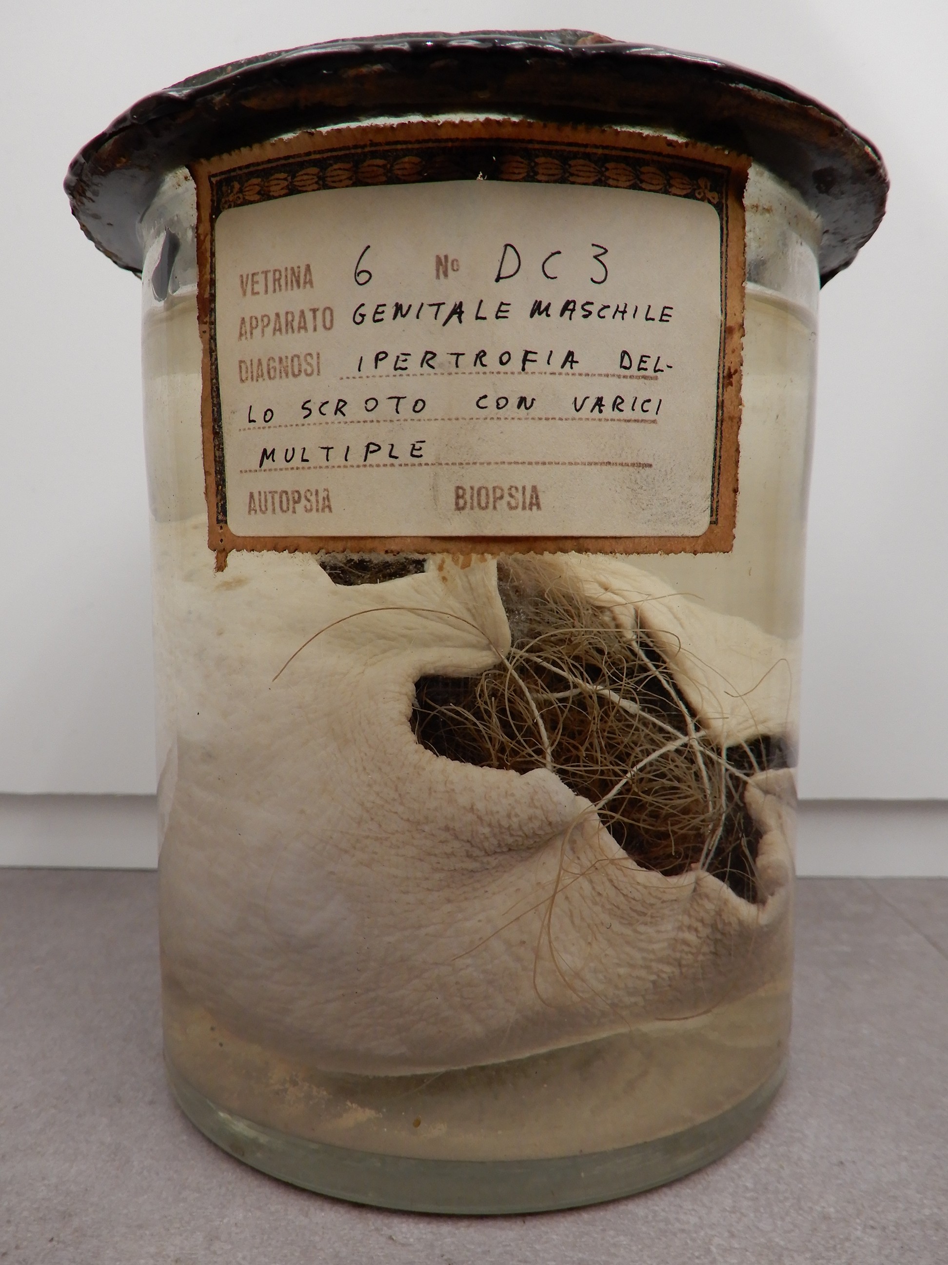 singolo reperto antropologico, preparato anatomico (morfologia alterata per patologia) (XIX-XX)