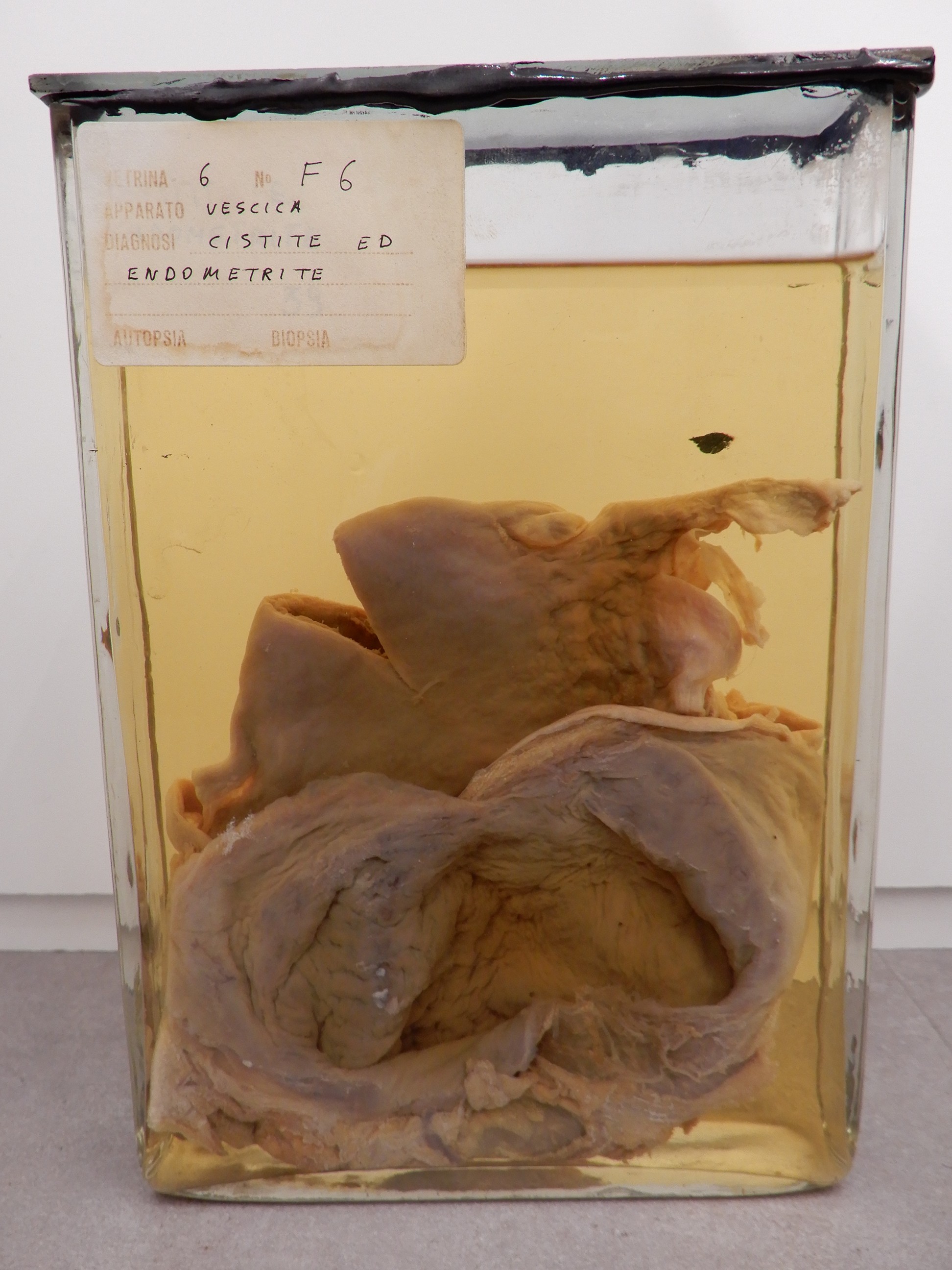 singolo reperto antropologico, preparato anatomico (morfologia alterata per patologia) (XIX-XX)