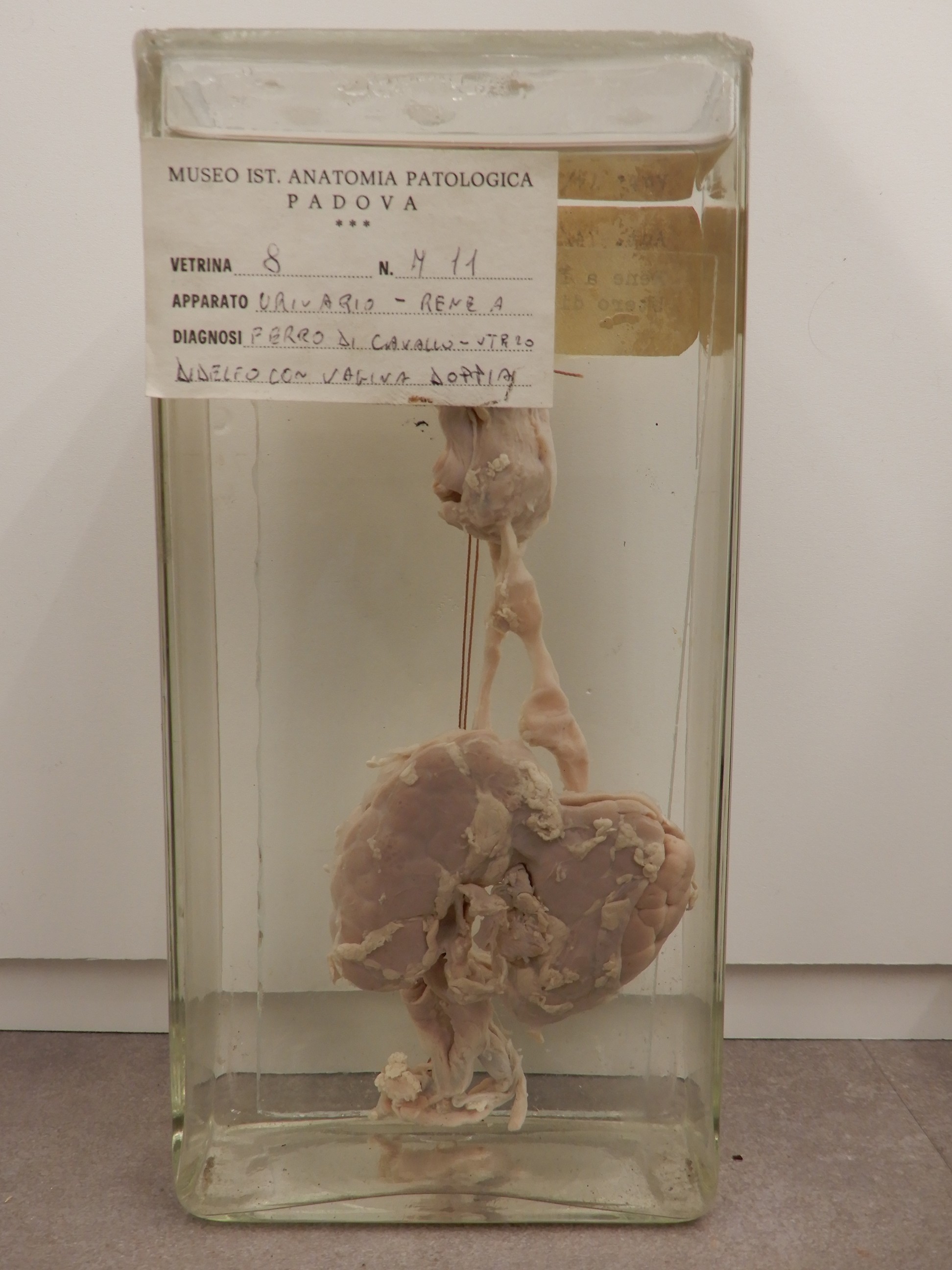 singolo reperto antropologico, preparato anatomico (morfologia alterata per patologia) (XIX-XX)