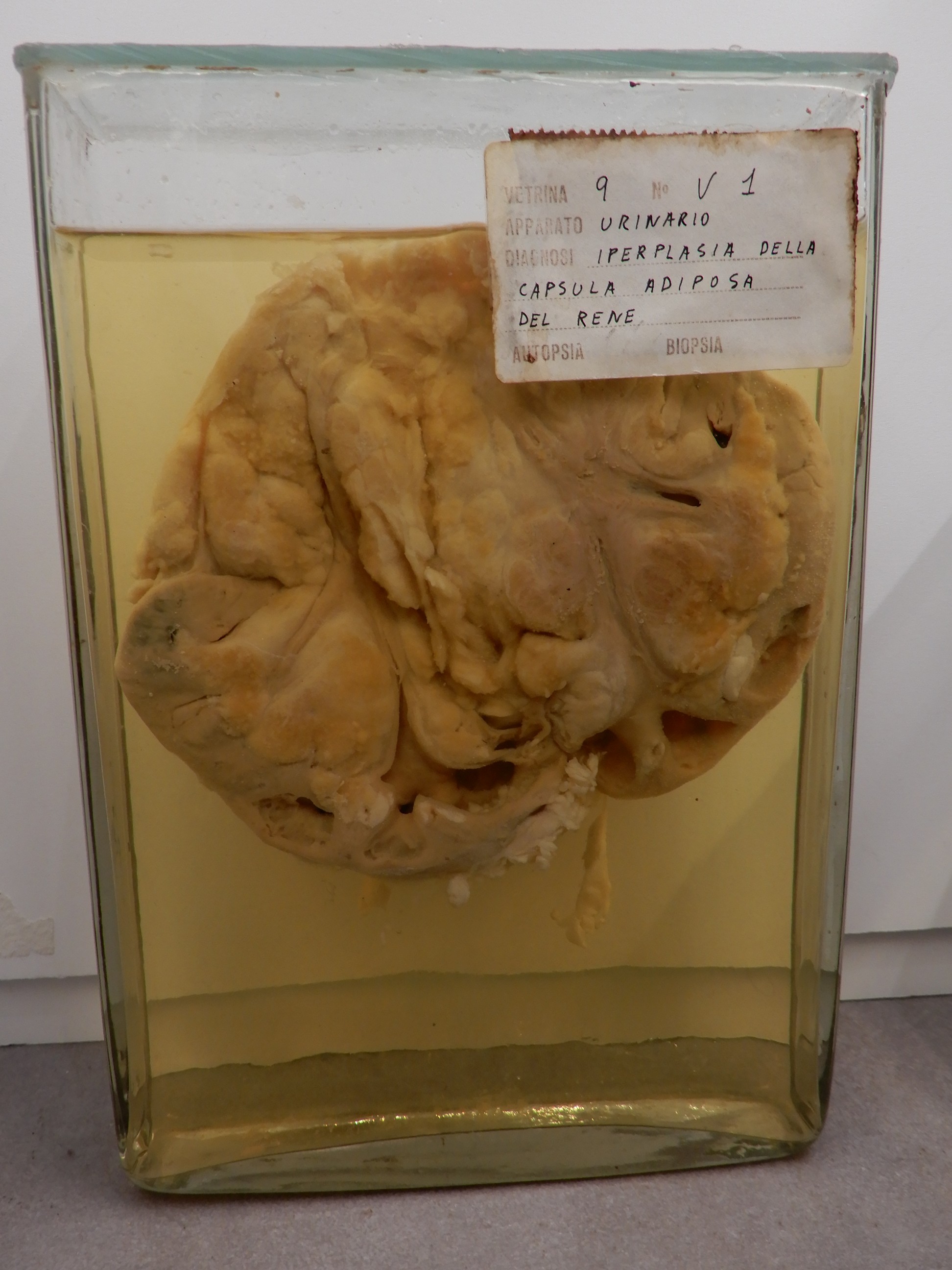 singolo reperto antropologico, preparato anatomico (morfologia alterata per patologia) (XIX-XX)