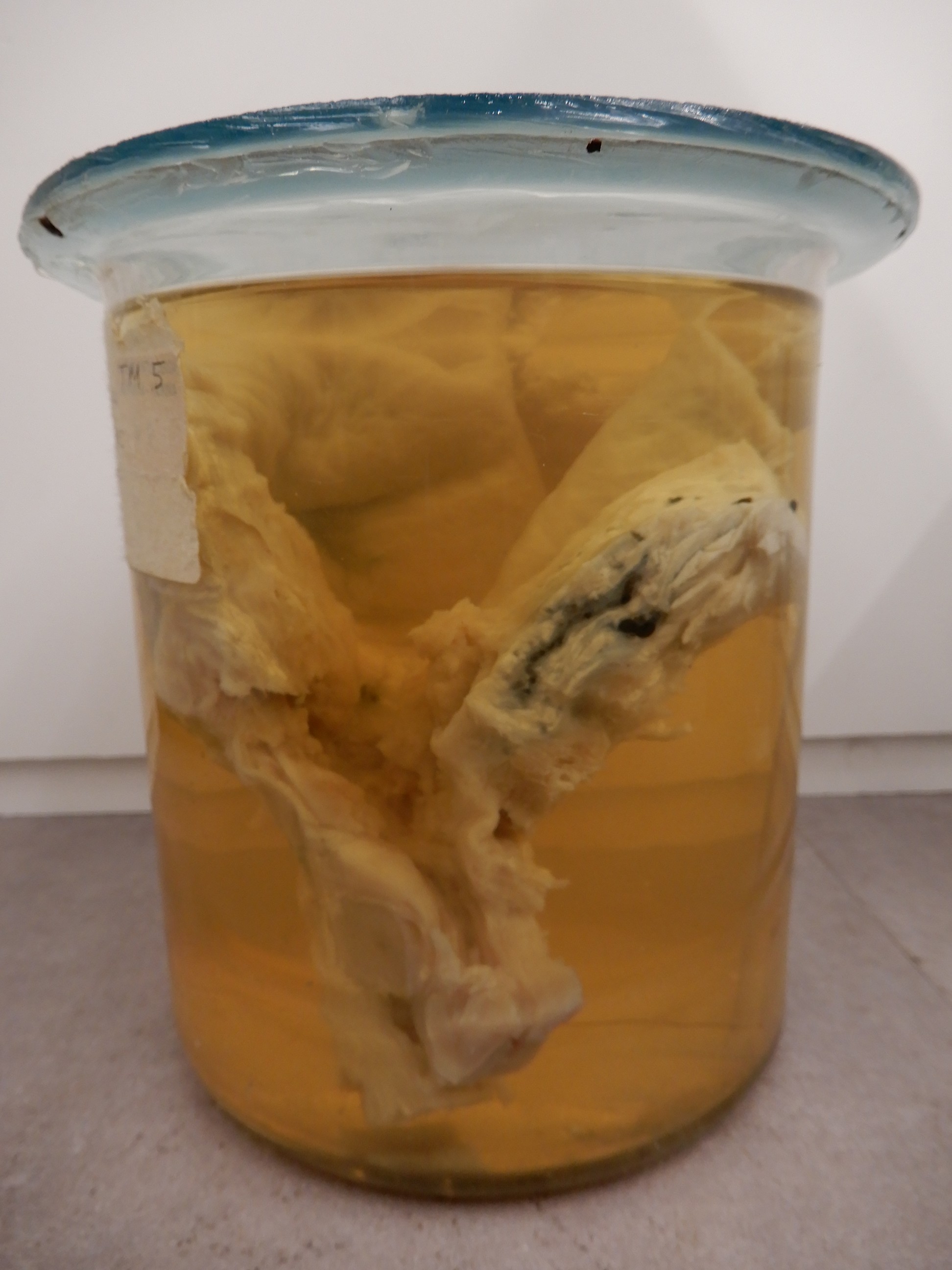 singolo reperto antropologico, preparato anatomico (morfologia alterata per patologia) (XIX-XX)