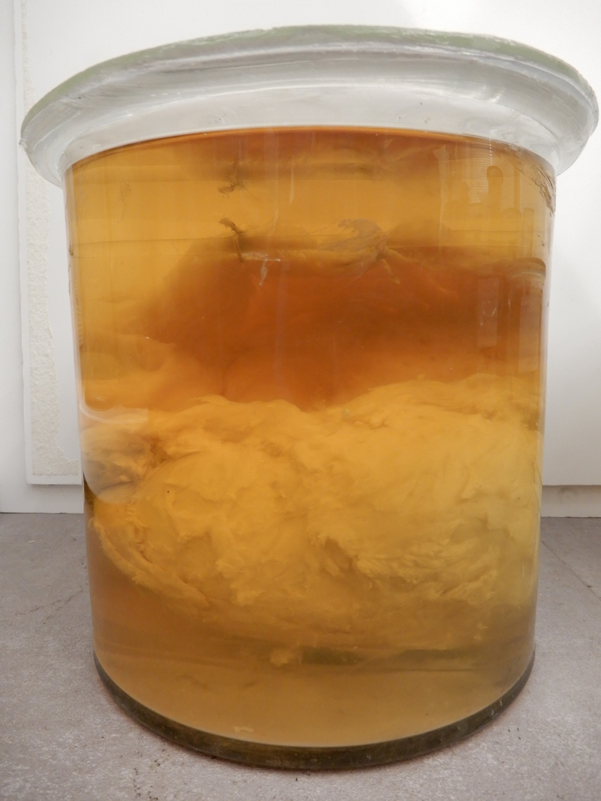 singolo reperto antropologico, preparato anatomico (morfologia alterata per patologia) (XIX-XX)