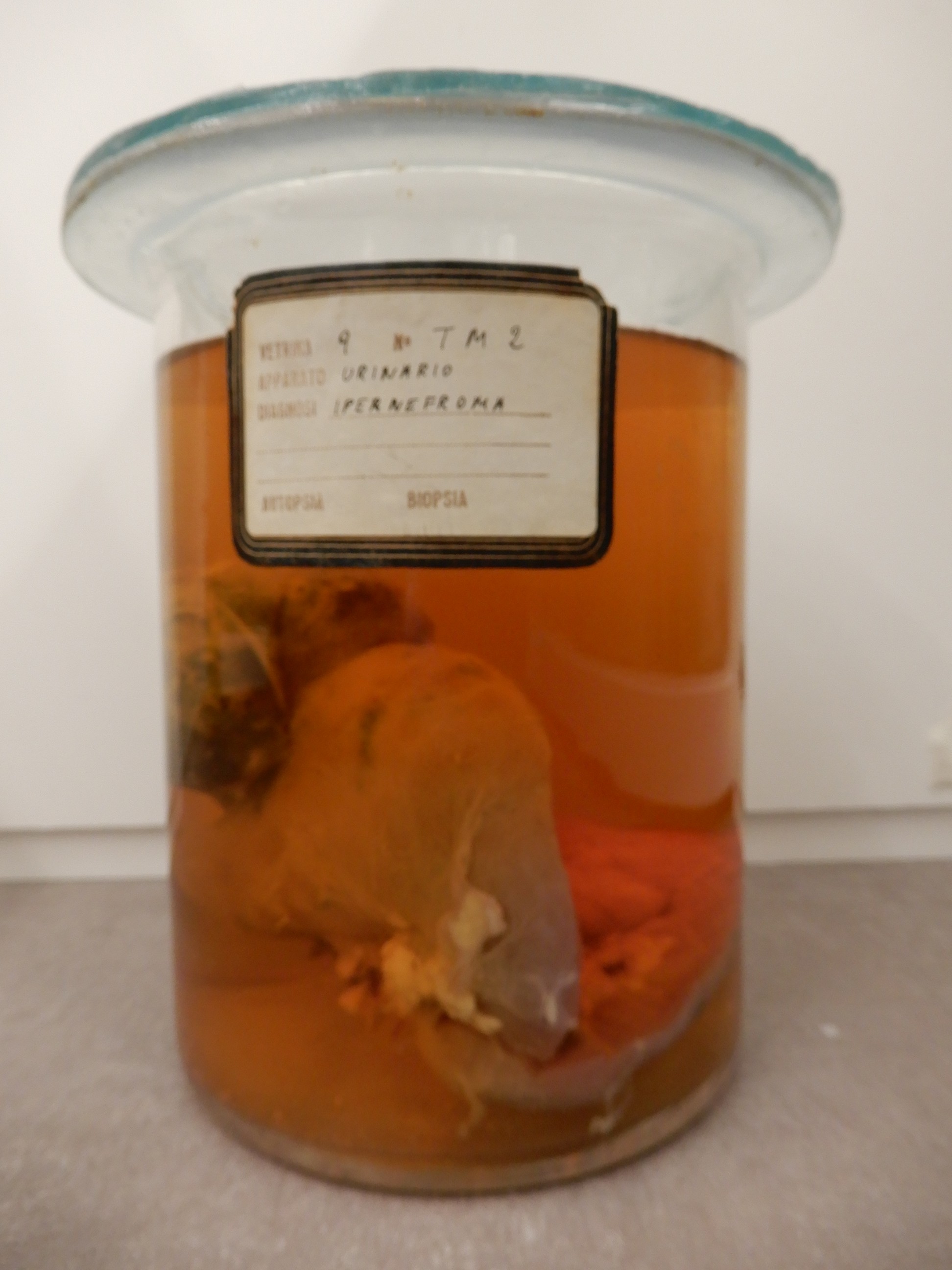 singolo reperto antropologico, preparato anatomico (morfologia alterata per patologia) (XIX-XX)