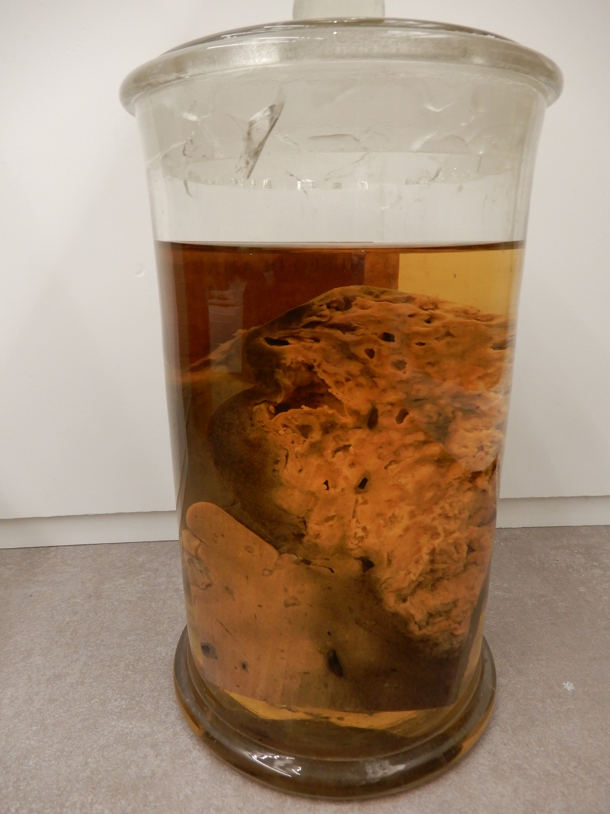 singolo reperto antropologico, preparato anatomico (morfologia alterata per patologia) (XIX-XX)