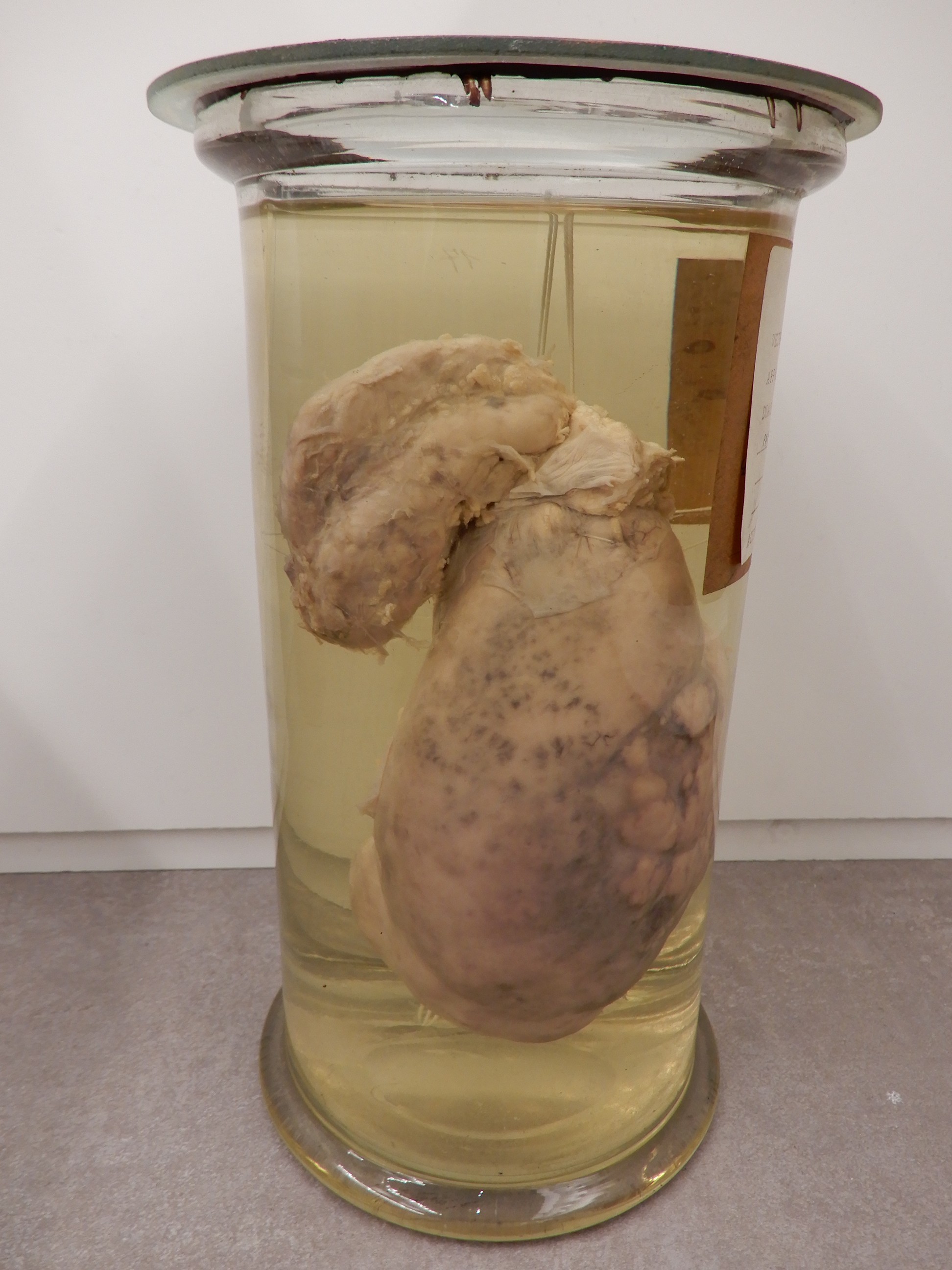 singolo reperto antropologico, preparato anatomico (morfologia alterata per patologia) (XIX-XX)