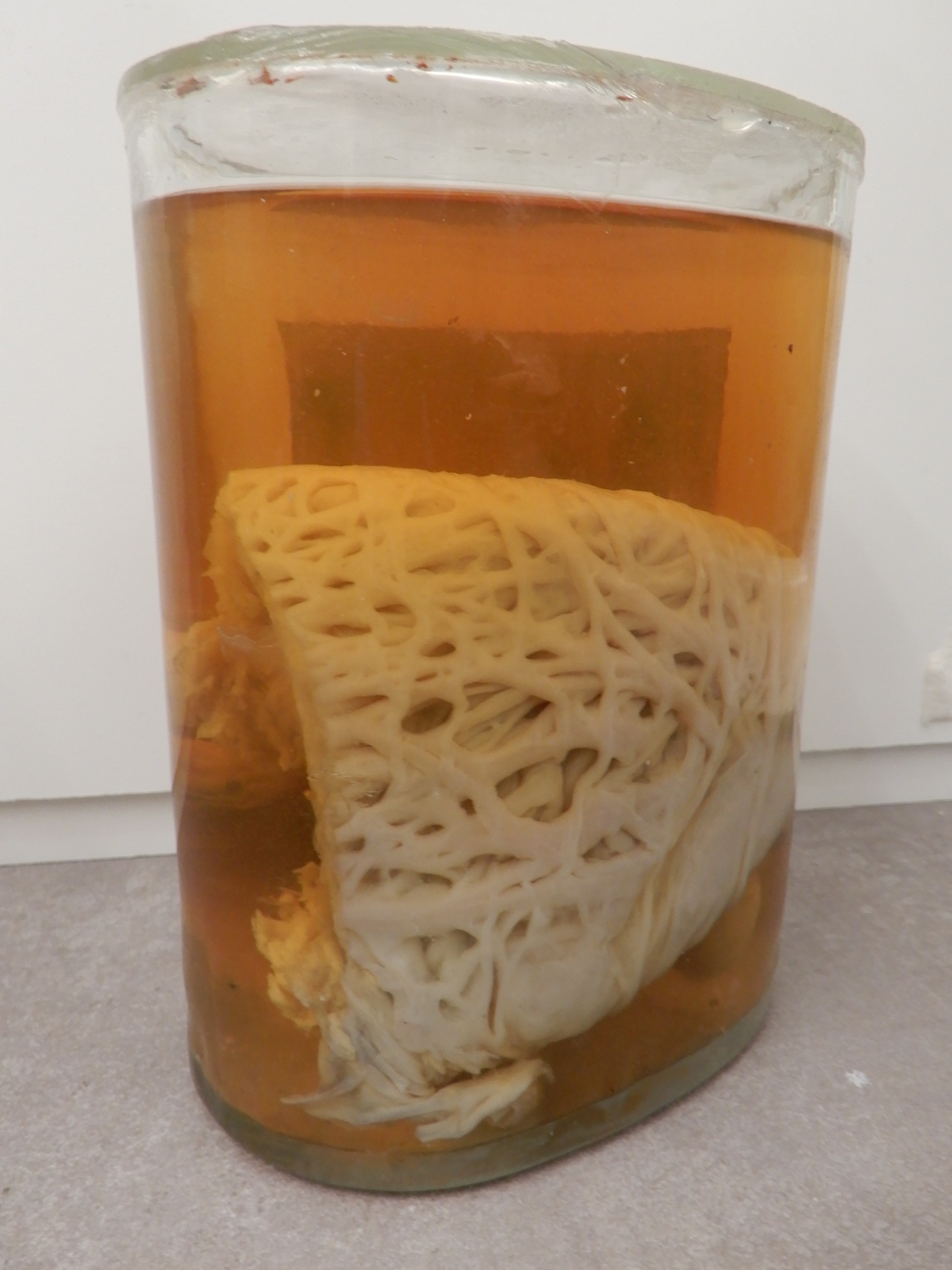 singolo reperto antropologico, preparato anatomico (morfologia alterata per patologia) (XIX-XX)