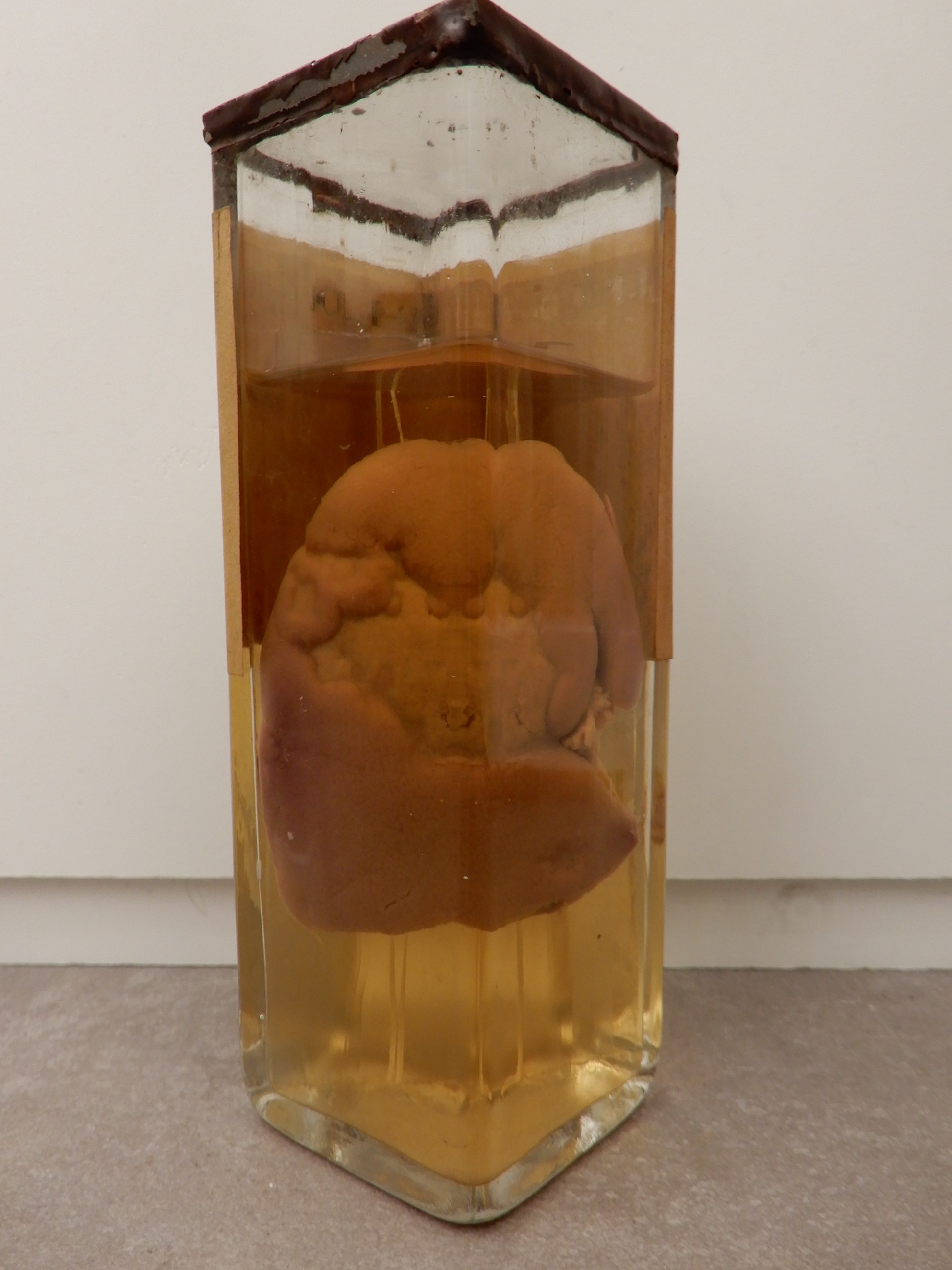 singolo reperto antropologico, preparato anatomico (morfologia alterata per patologia) (XIX-XX)