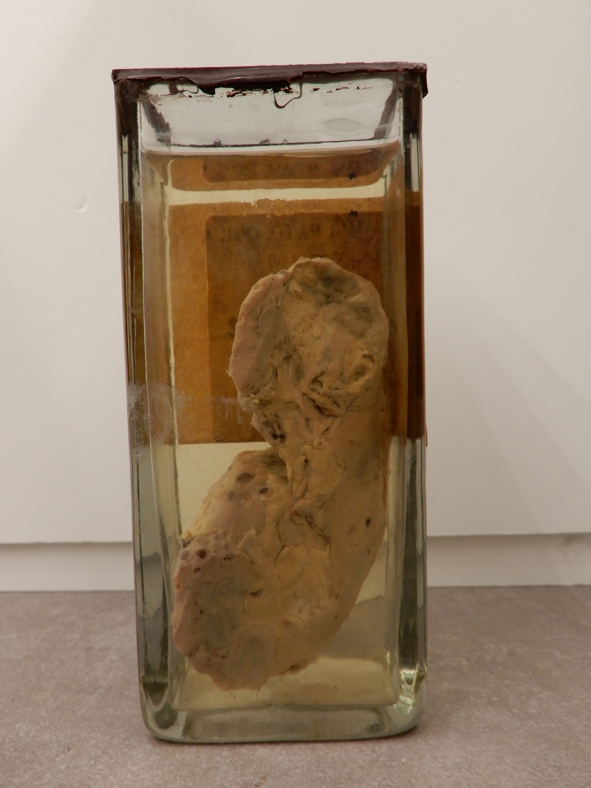 singolo reperto antropologico, preparato anatomico (morfologia alterata per patologia) (XIX-XX)