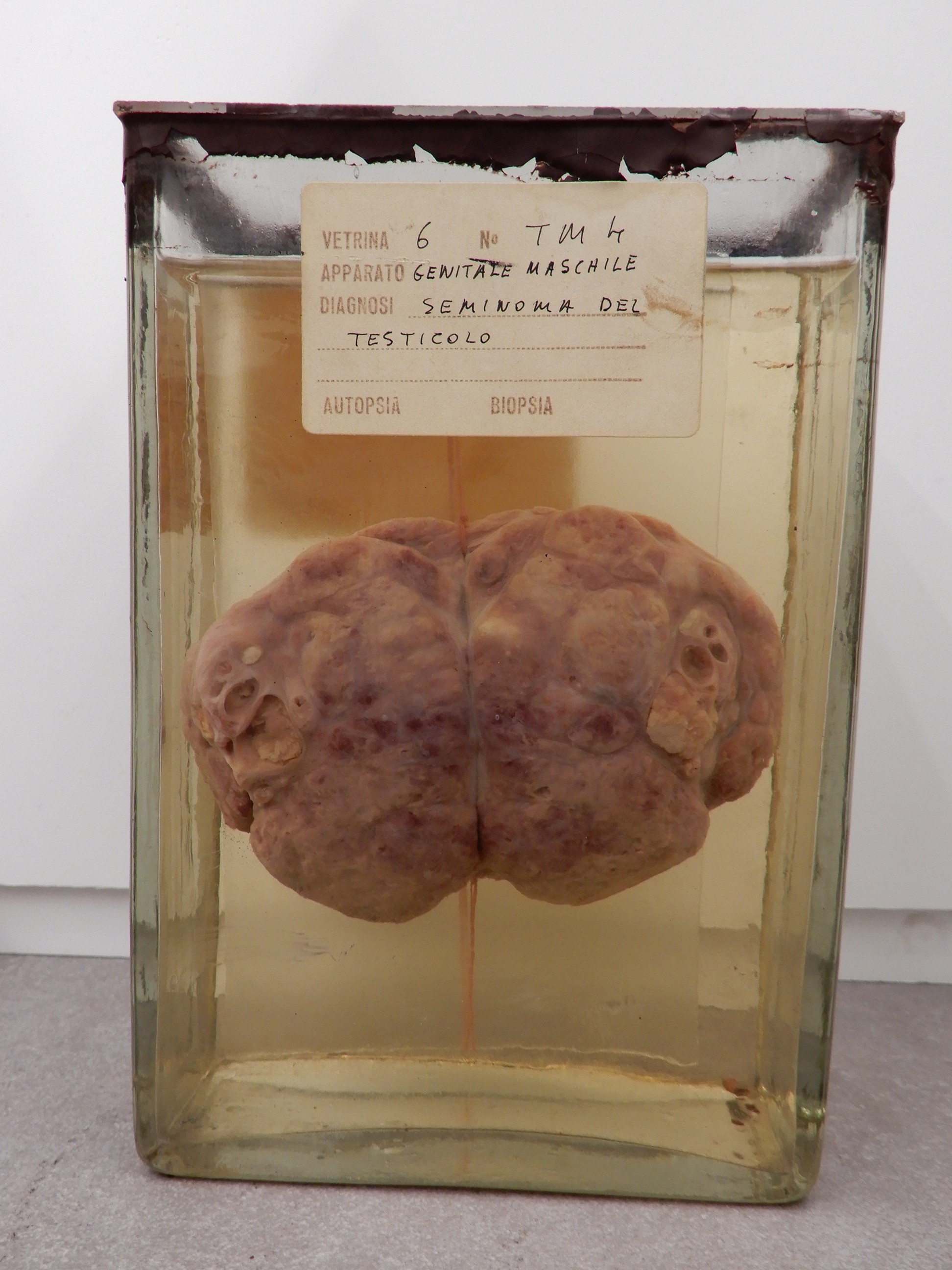 singolo reperto antropologico, preparato anatomico (morfologia alterata per patologia) (XIX-XX)