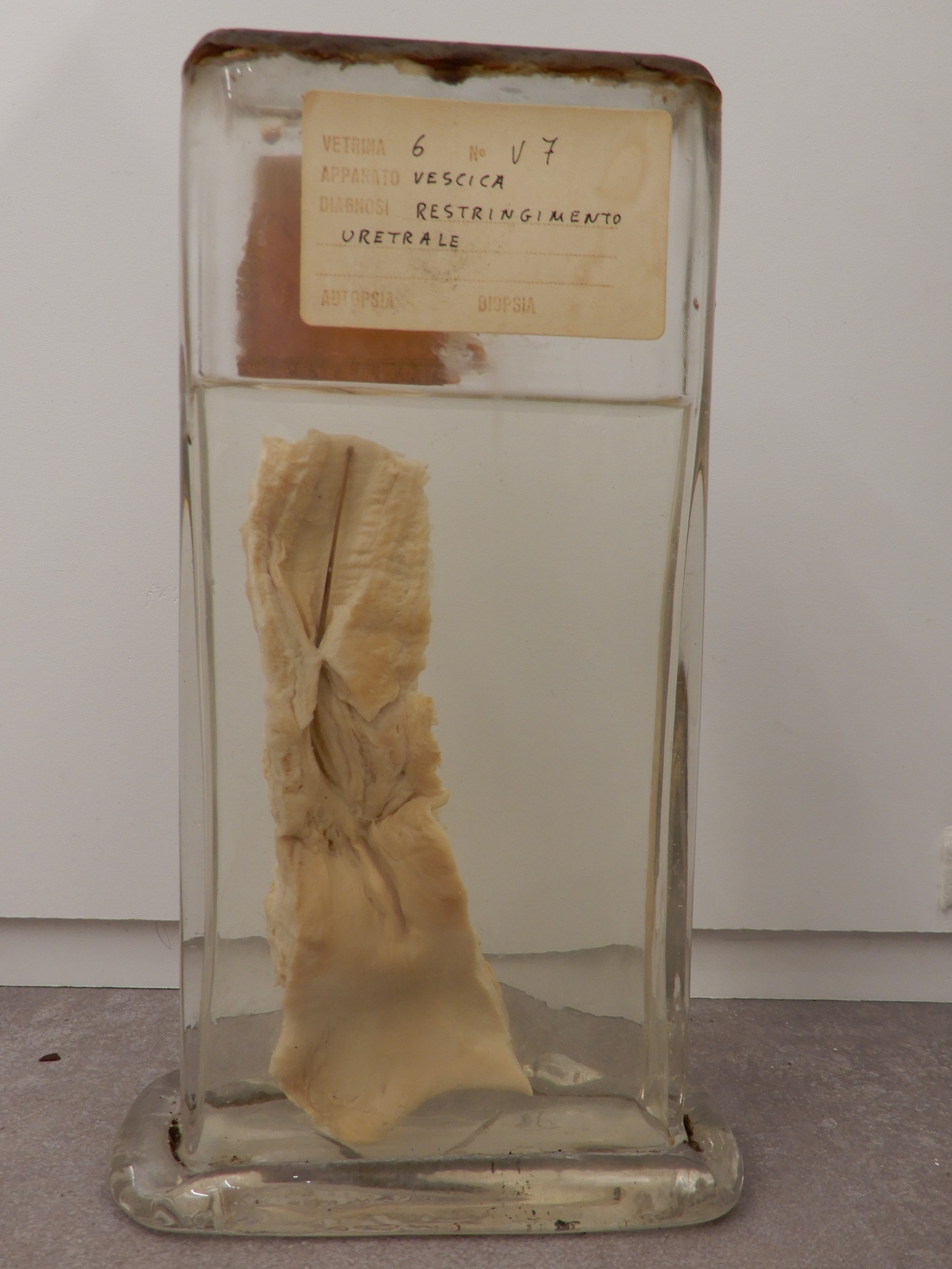 singolo reperto antropologico, preparato anatomico (morfologia alterata per patologia) (XIX-XX)