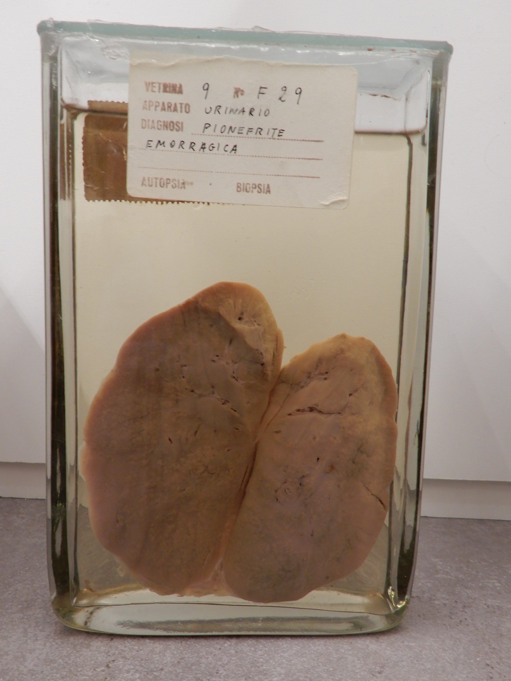 singolo reperto antropologico, preparato anatomico (morfologia alterata per patologia) (XIX-XX)