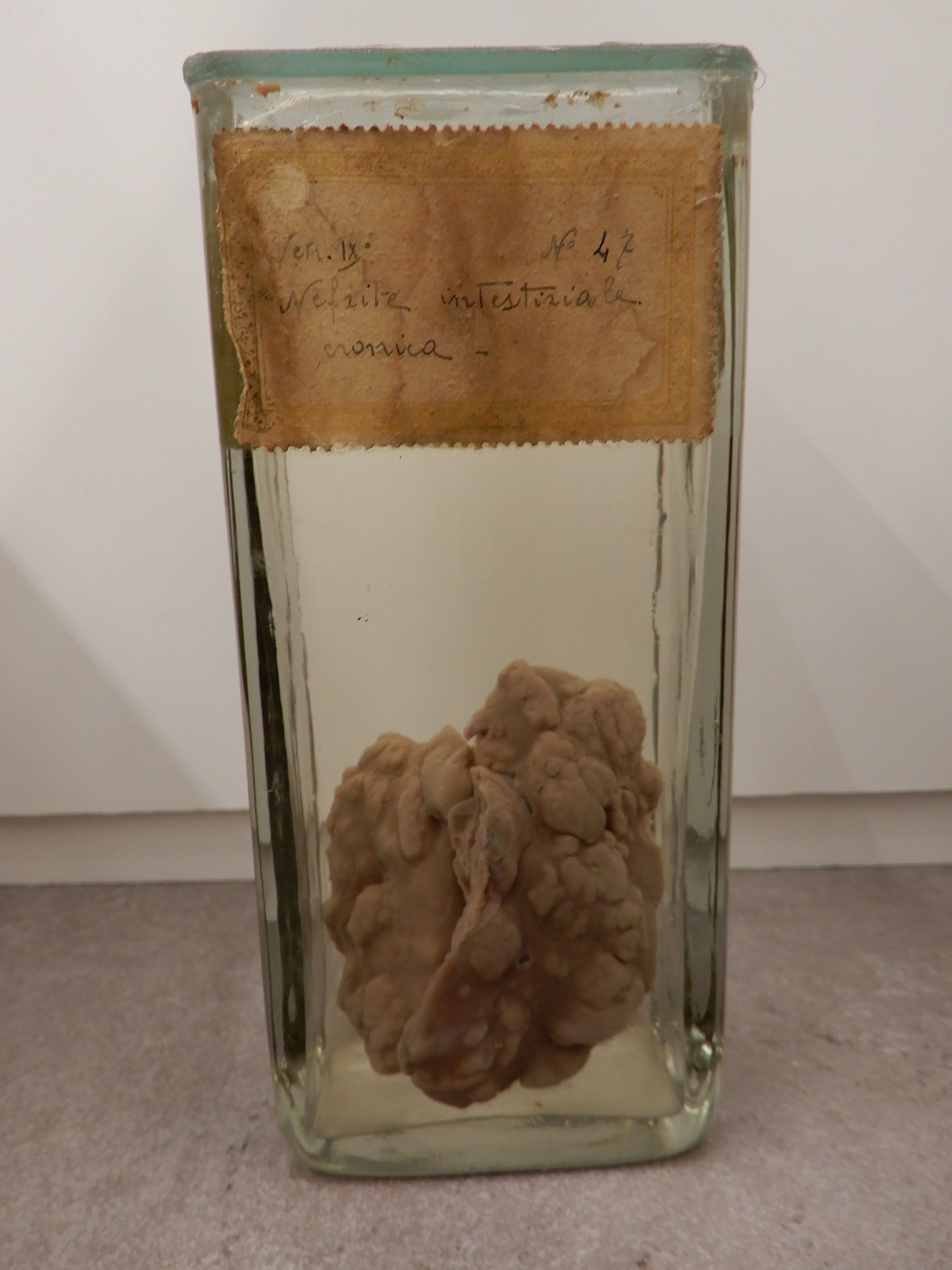 singolo reperto antropologico, preparato anatomico (morfologia alterata per patologia) (XIX-XX)