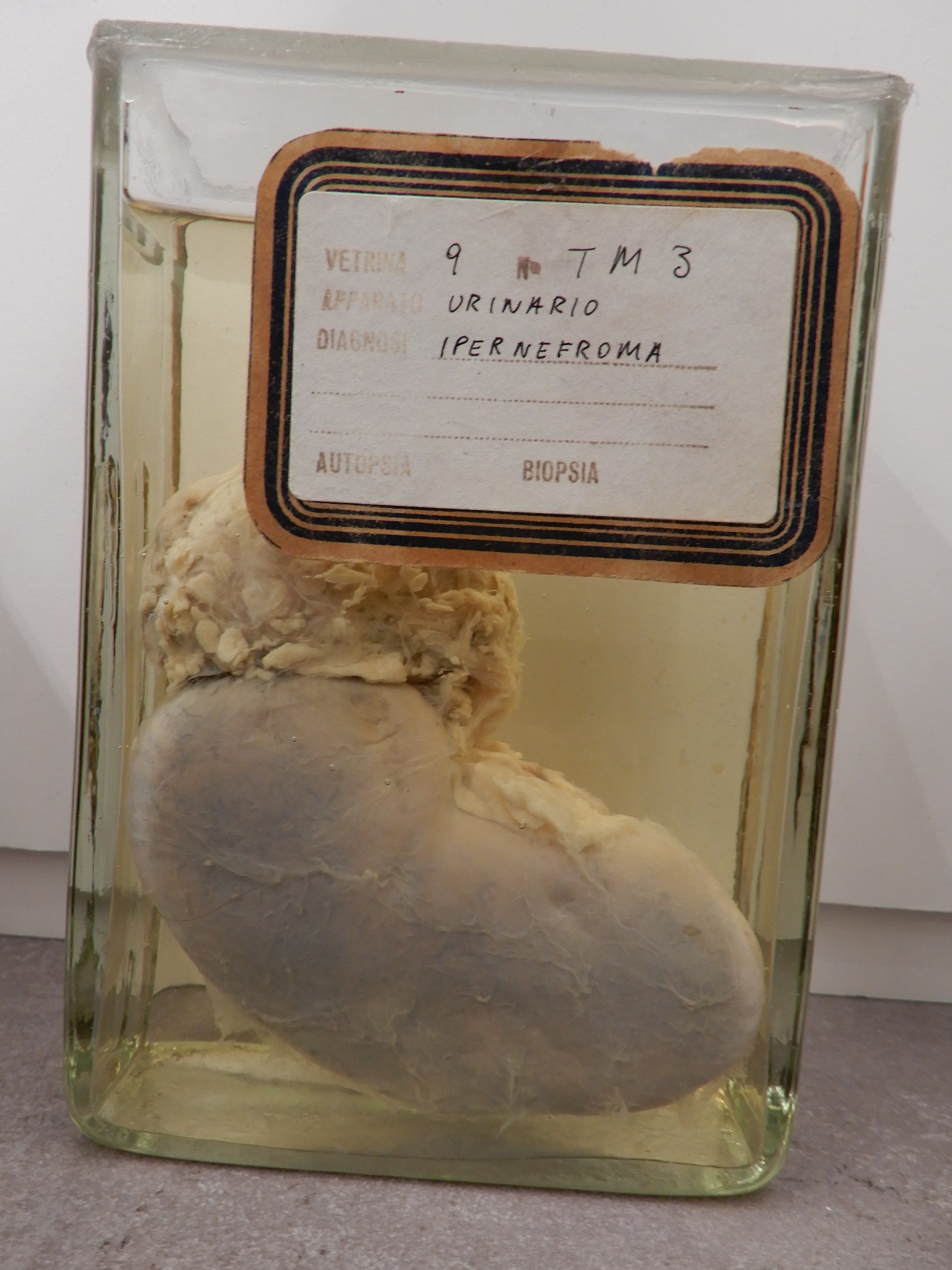 singolo reperto antropologico, preparato anatomico (morfologia alterata per patologia) (XIX-XX)