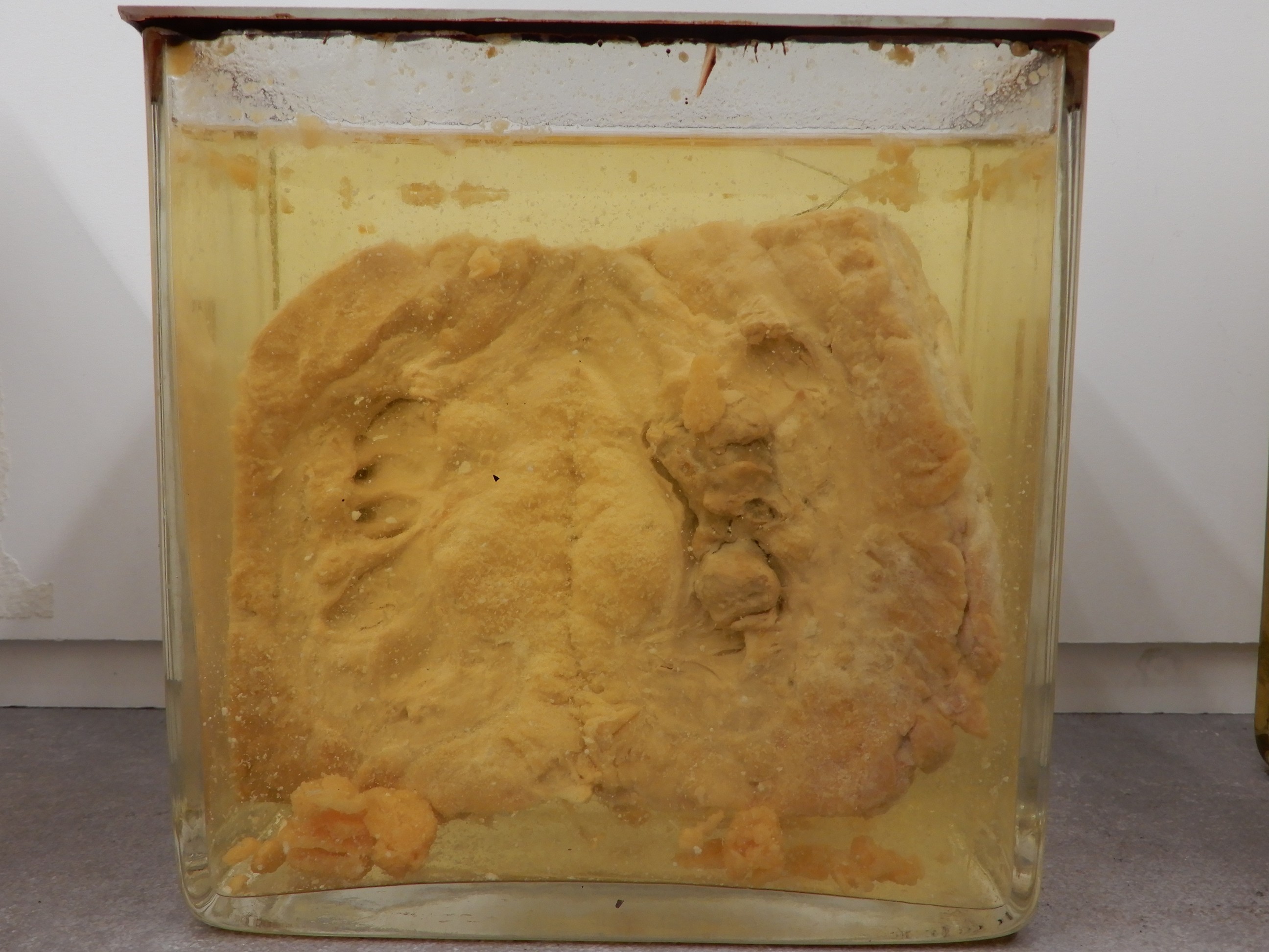 singolo reperto antropologico, preparato anatomico (morfologia alterata per patologia) (XIX-XX)