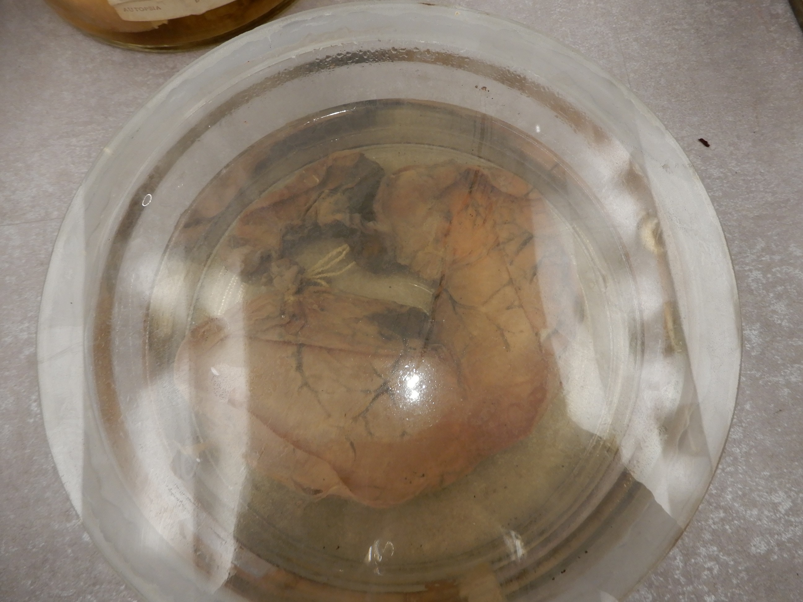 singolo reperto antropologico, preparato anatomico (morfologia alterata per patologia) (XIX-XX)