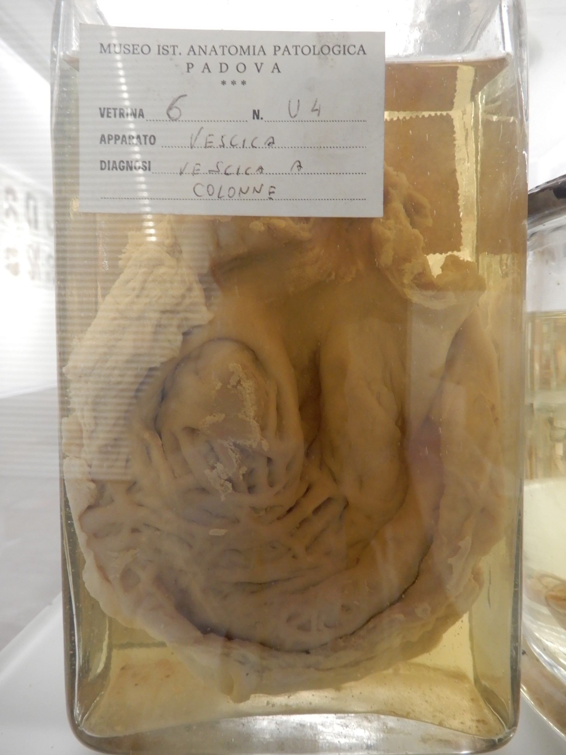 singolo reperto antropologico, preparato anatomico (morfologia alterata per patologia) (XIX-XX)