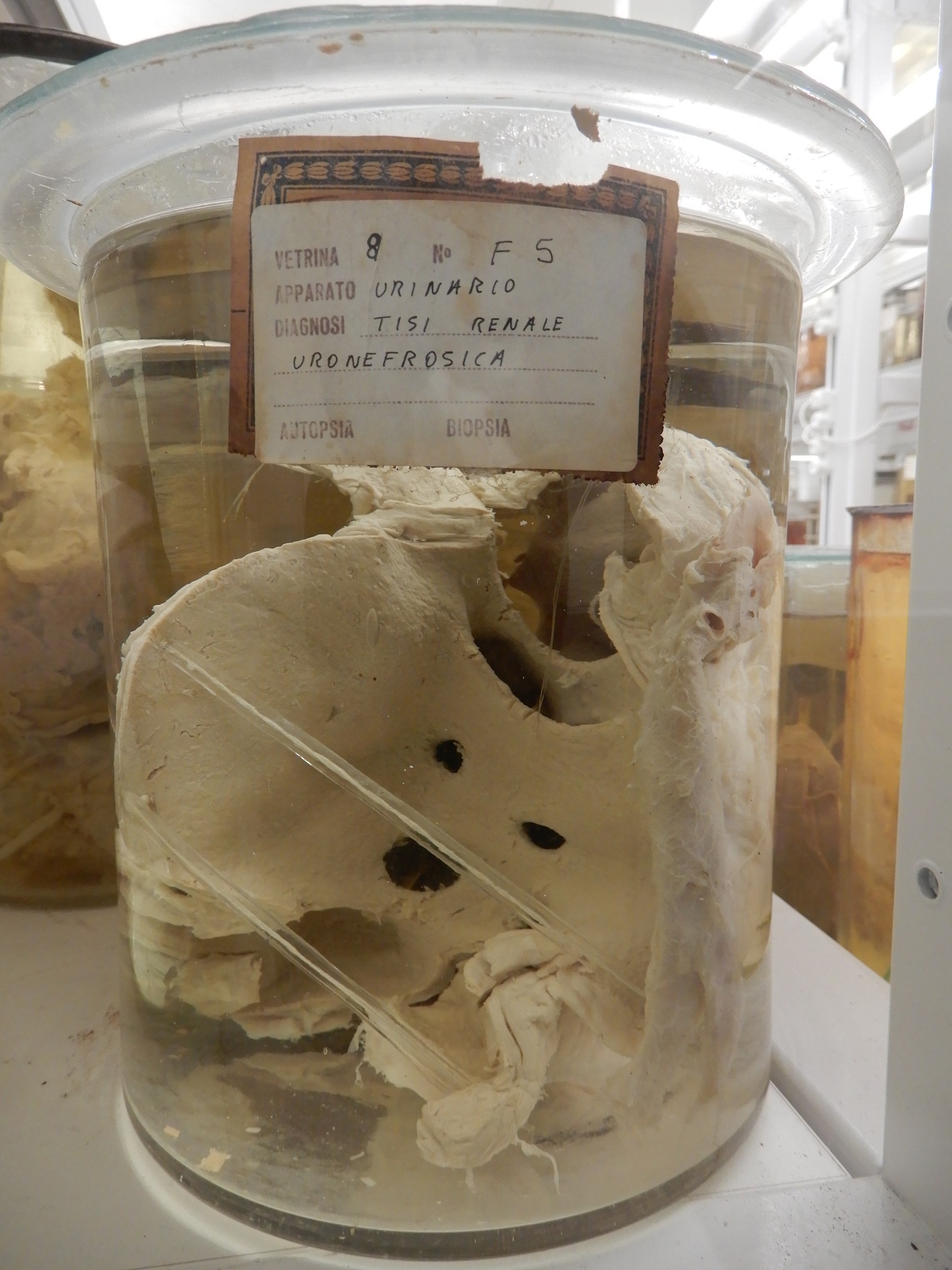 singolo reperto antropologico, preparato anatomico (morfologia alterata per patologia) (XIX-XX)