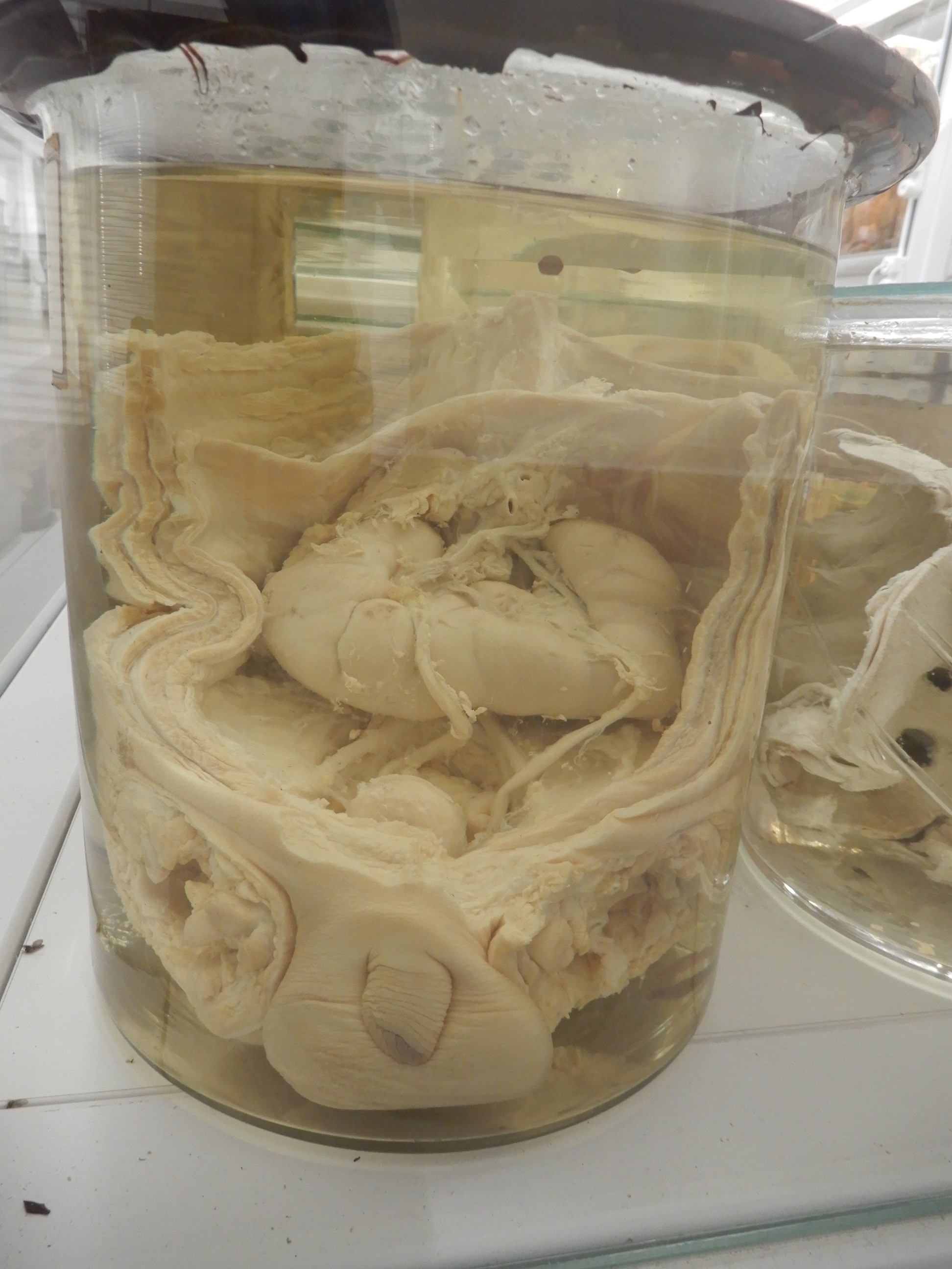 singolo reperto antropologico, preparato anatomico (morfologia alterata per patologia) (XIX-XX)