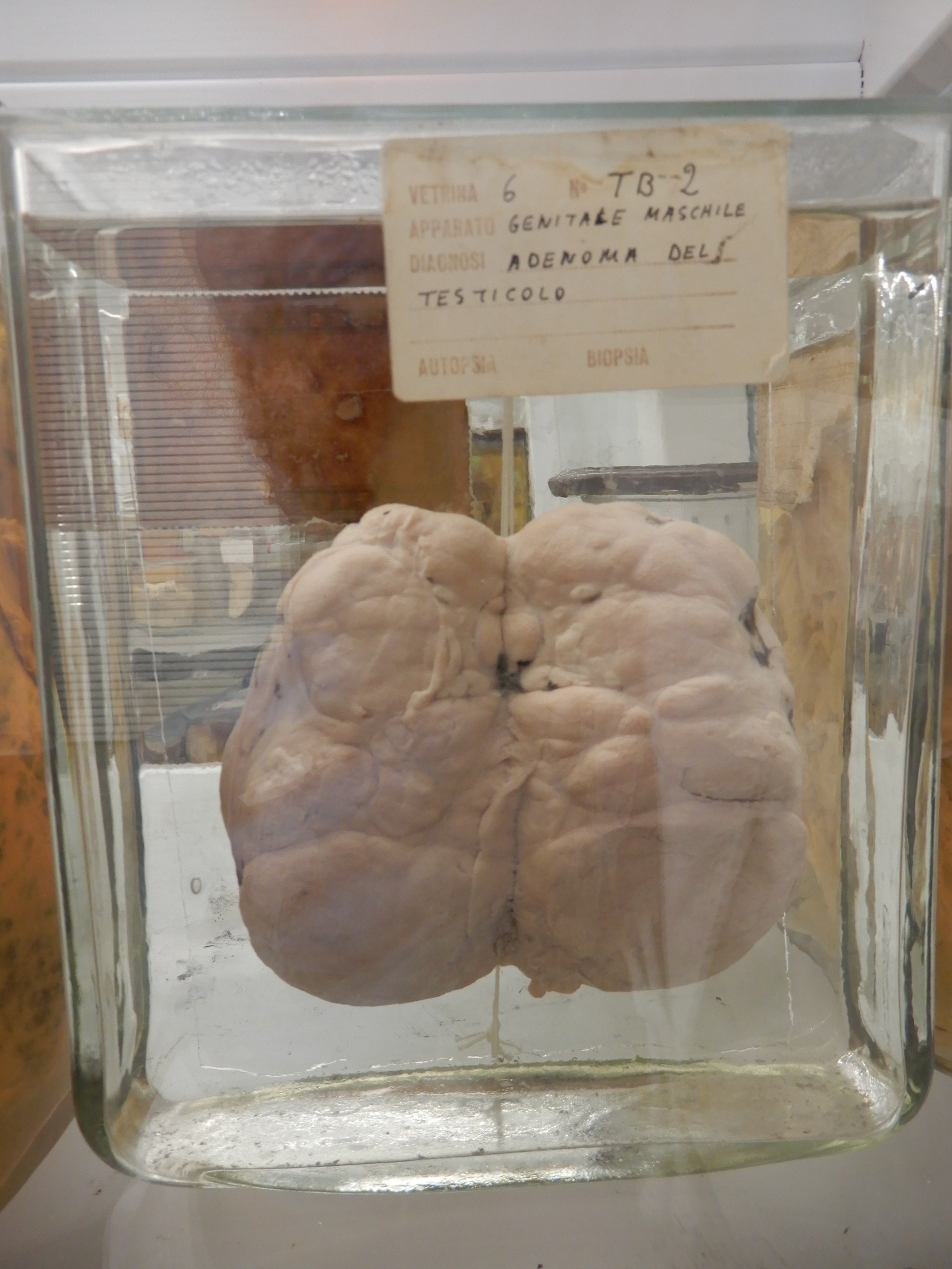 singolo reperto antropologico, preparato anatomico (morfologia alterata per patologia) (XIX-XX)