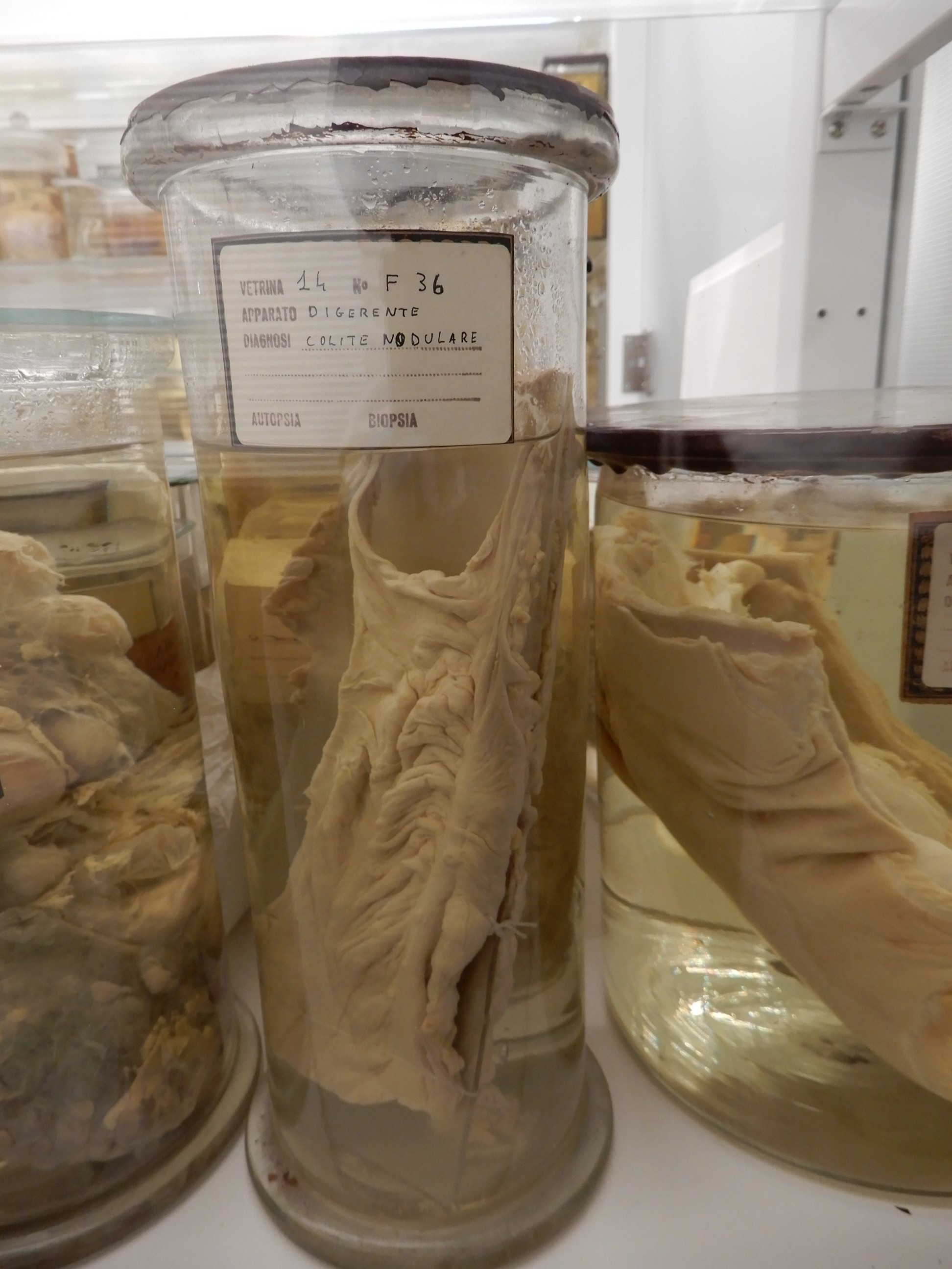 singolo reperto antropologico, preparato anatomico (morfologia alterata per patologia) (XIX-XX)