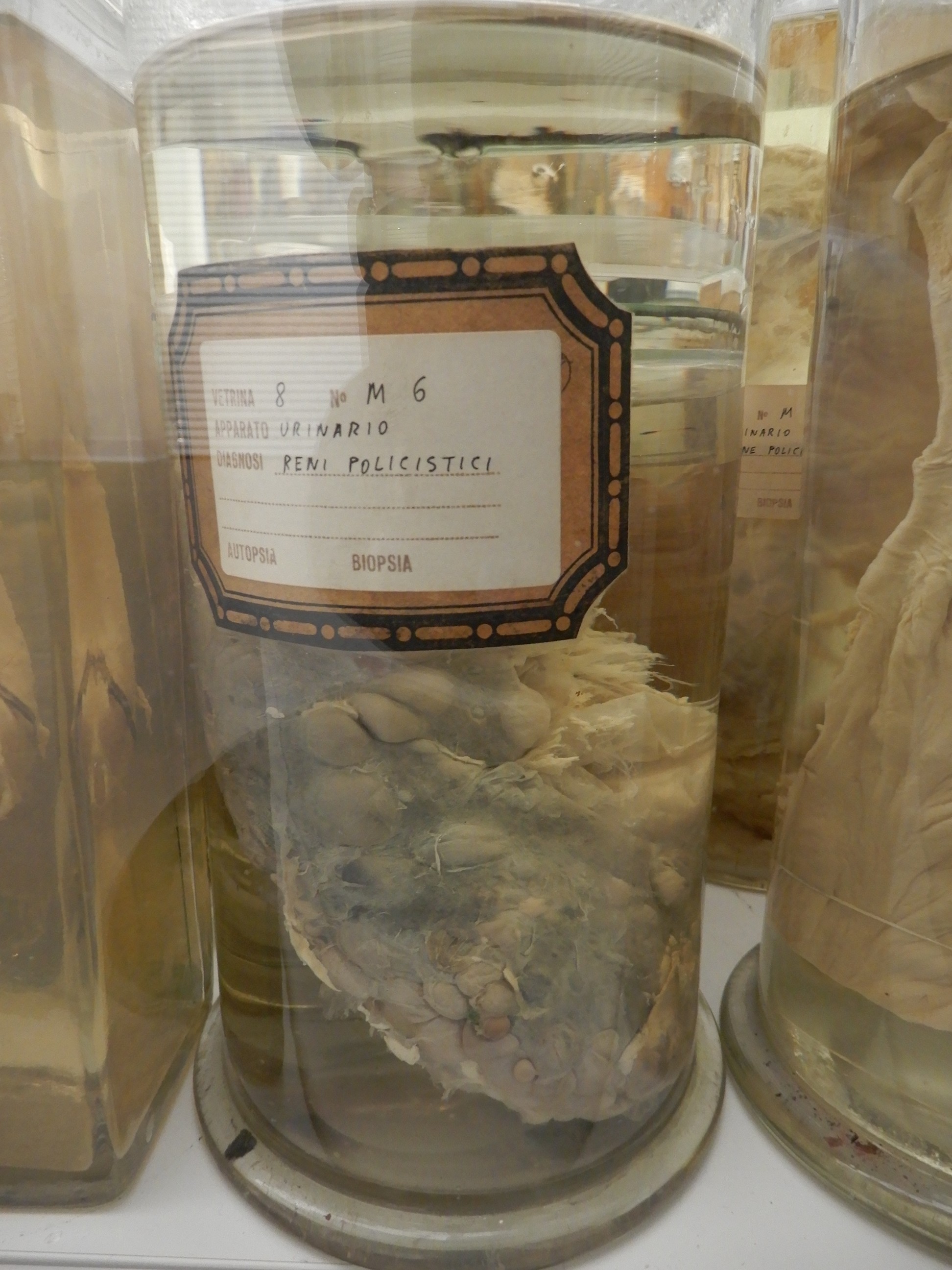 singolo reperto antropologico, preparato anatomico (morfologia alterata per patologia) (XIX-XX)