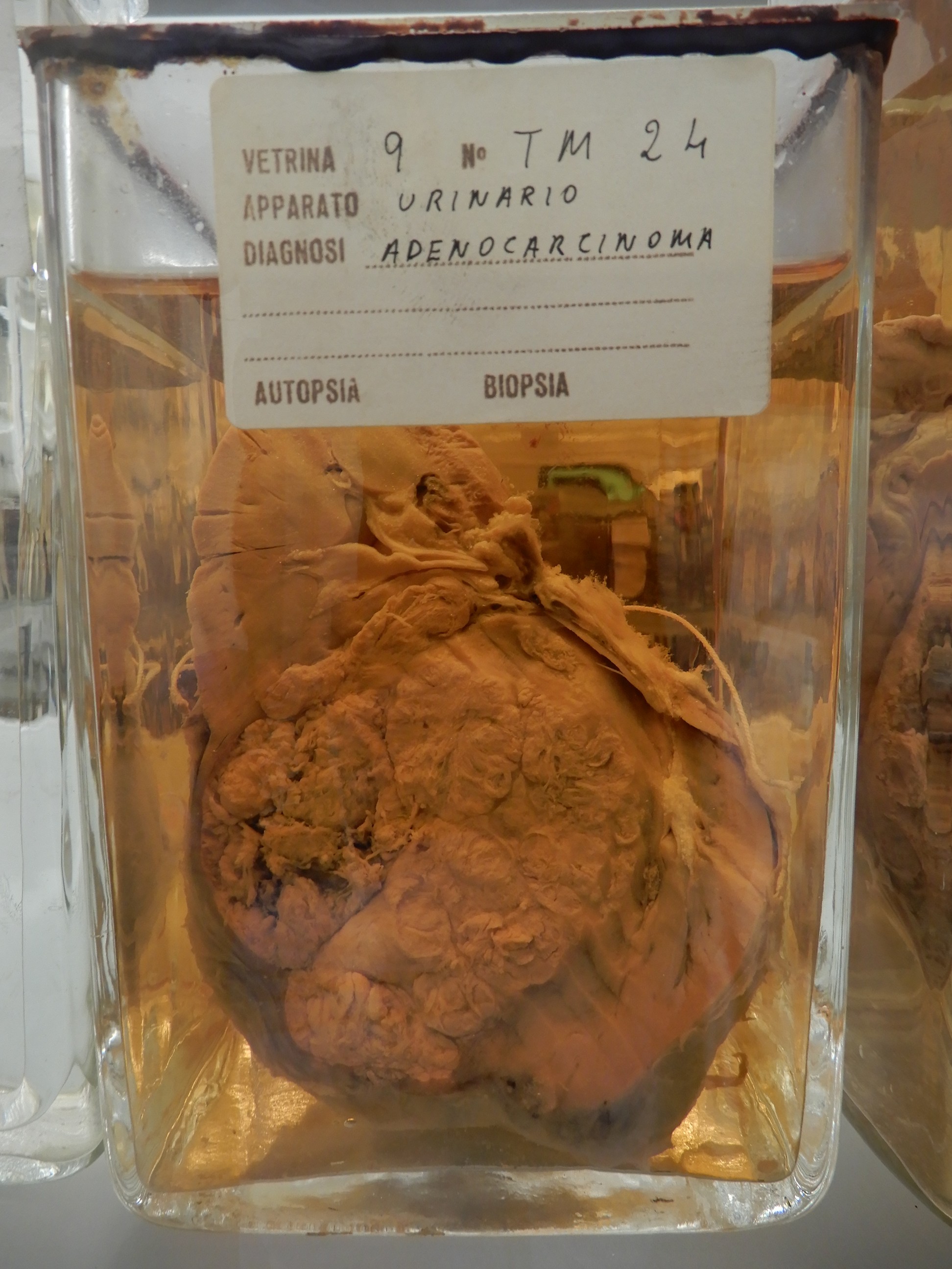 singolo reperto antropologico, preparato anatomico (morfologia alterata per patologia) (XIX-XX)