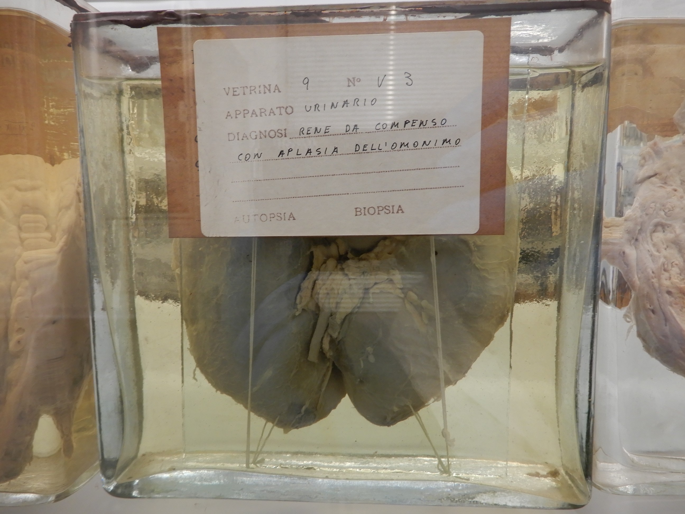 singolo reperto antropologico, preparato anatomico (morfologia alterata per patologia) (XIX-XX)