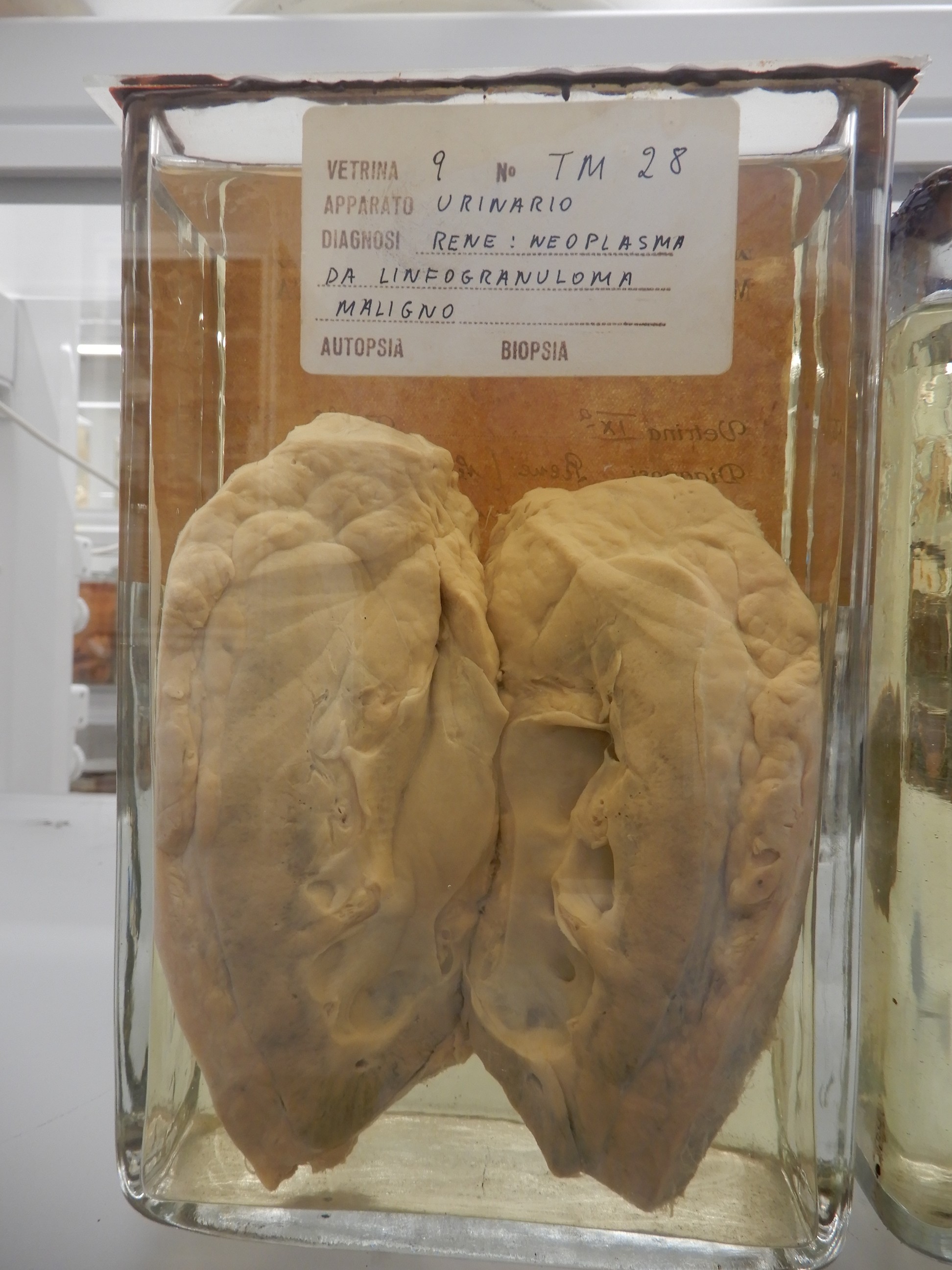 singolo reperto antropologico, preparato anatomico (morfologia alterata per patologia) (XIX-XX)