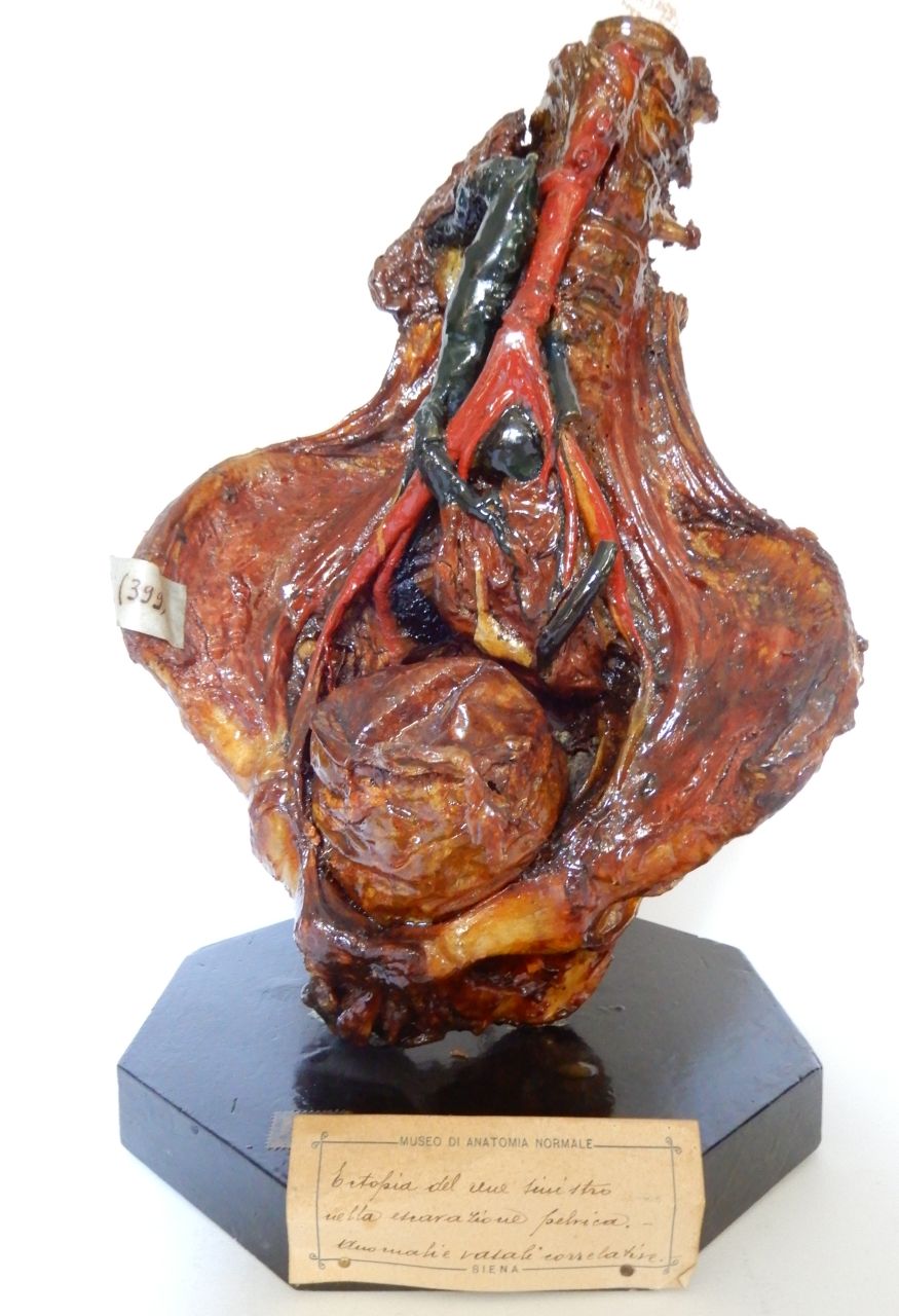 singolo reperto antropologico, preparato anatomico, rene (morfologia/ struttura alterata post mortem per intervento antropico, trattato e colorato) (XIX)