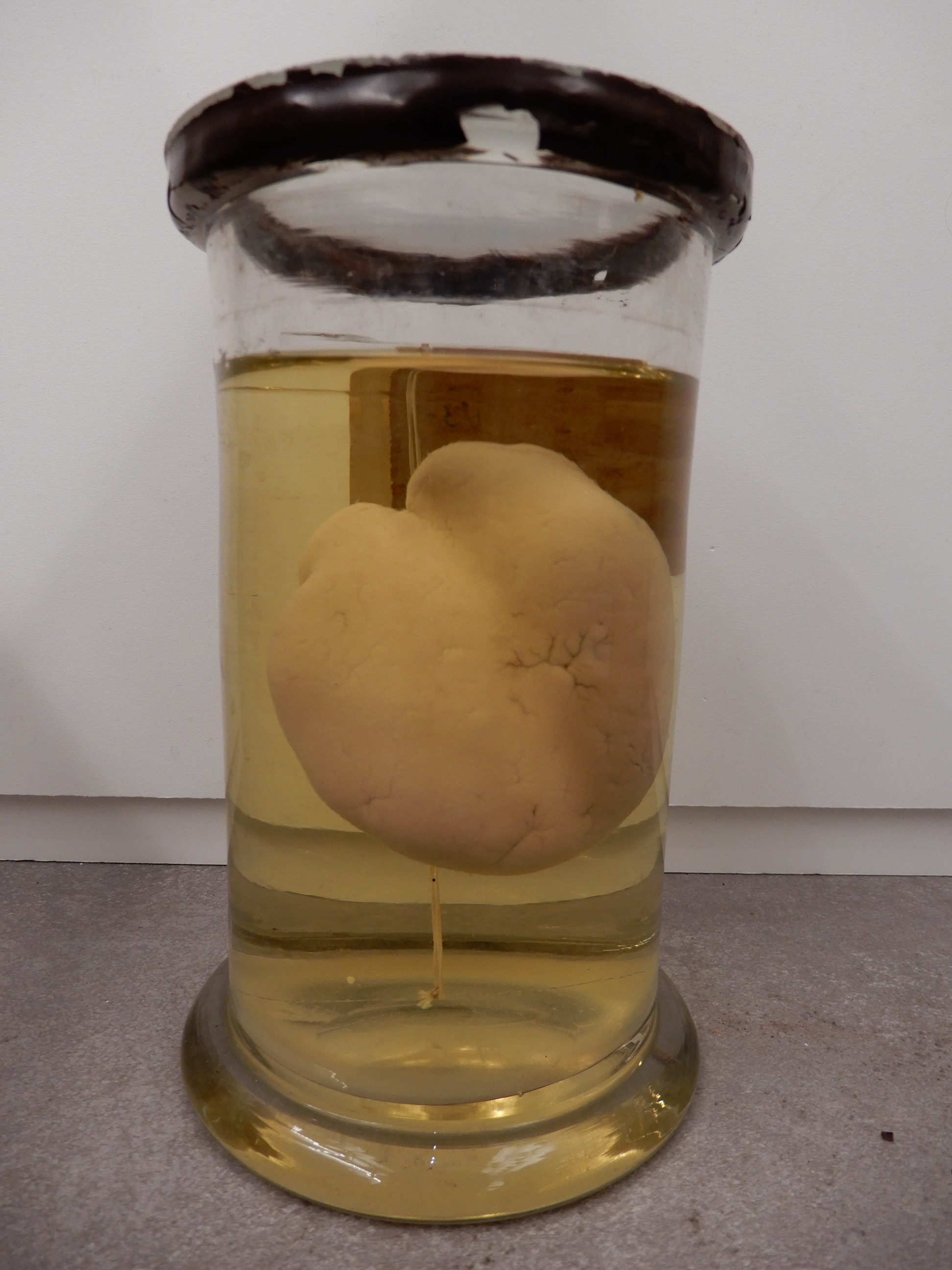 singolo reperto antropologico, preparato anatomico (morfologia alterata per patologia) (XIX-XX)