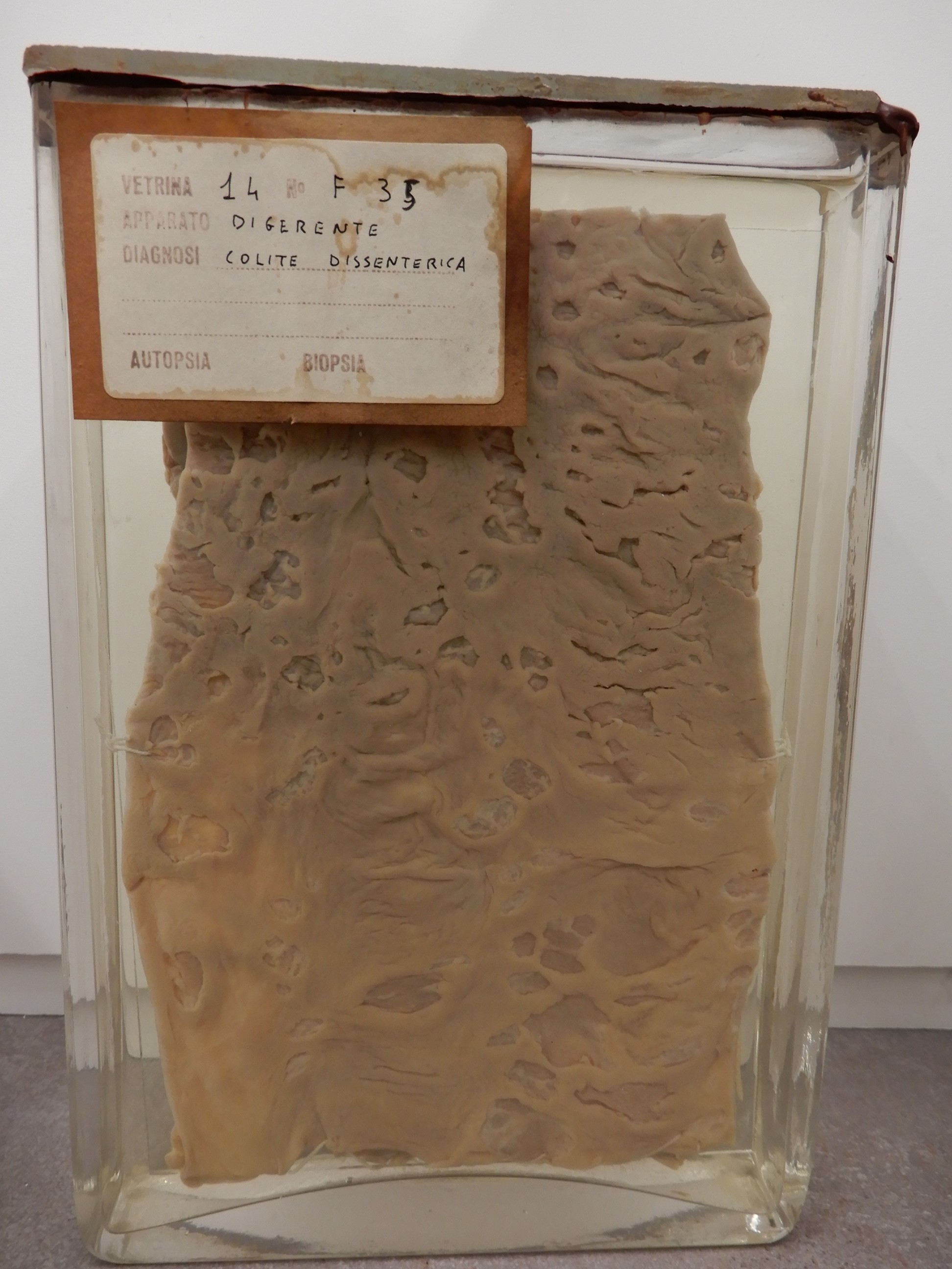 singolo reperto antropologico, preparato anatomico (morfologia alterata per patologia) (XIX-XX)