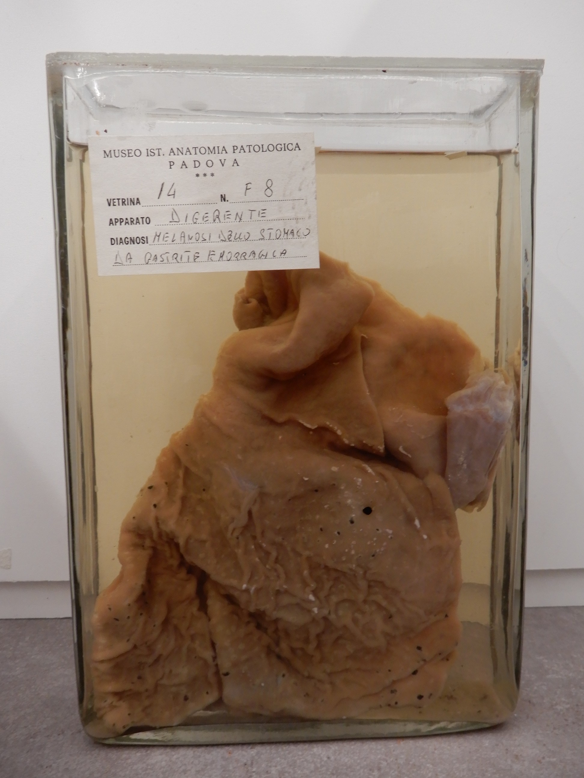 singolo reperto antropologico, preparato anatomico (morfologia alterata per patologia) (XIX-XX)