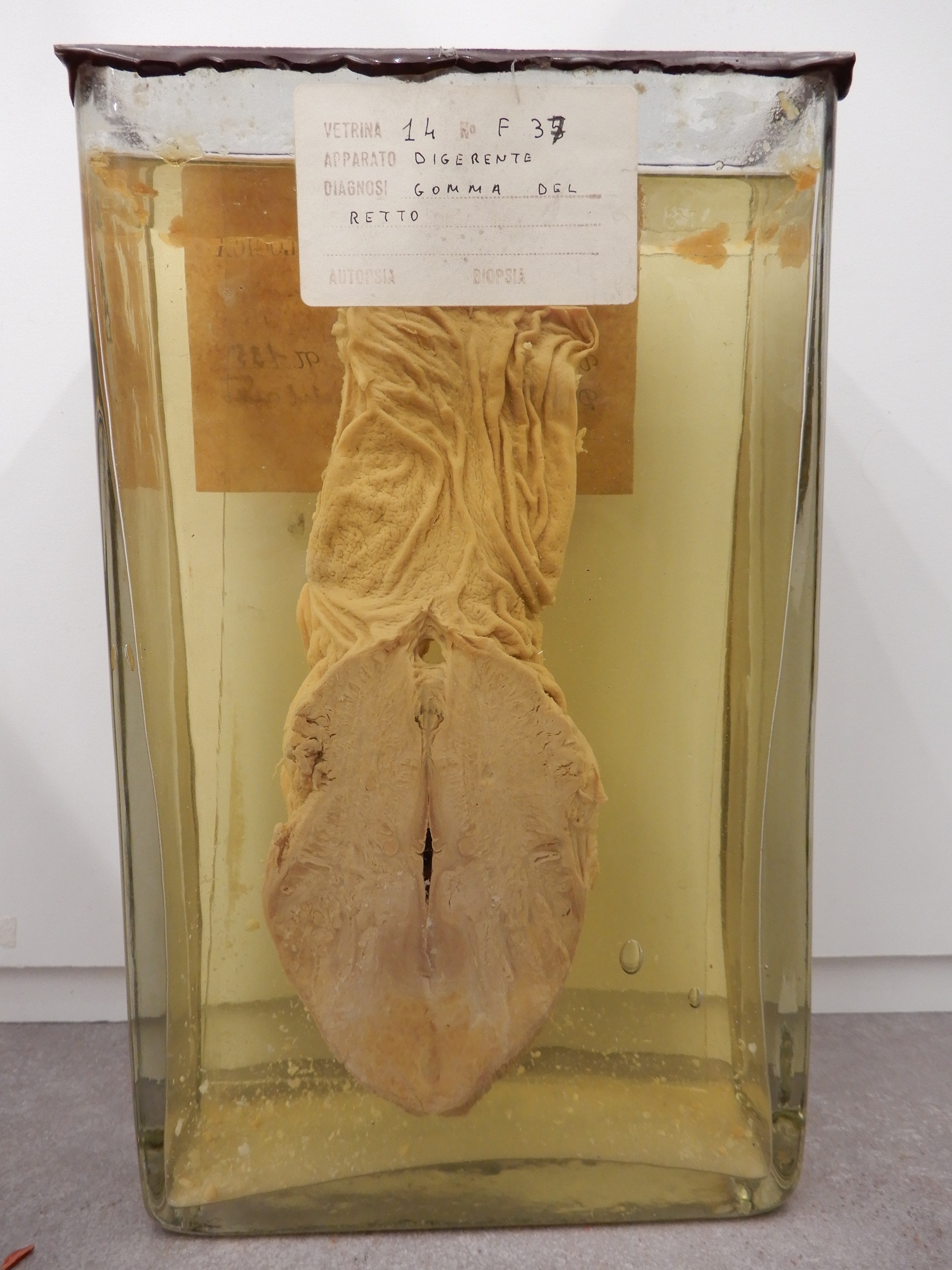 singolo reperto antropologico, preparato anatomico (morfologia alterata per patologia) (XIX-XX)